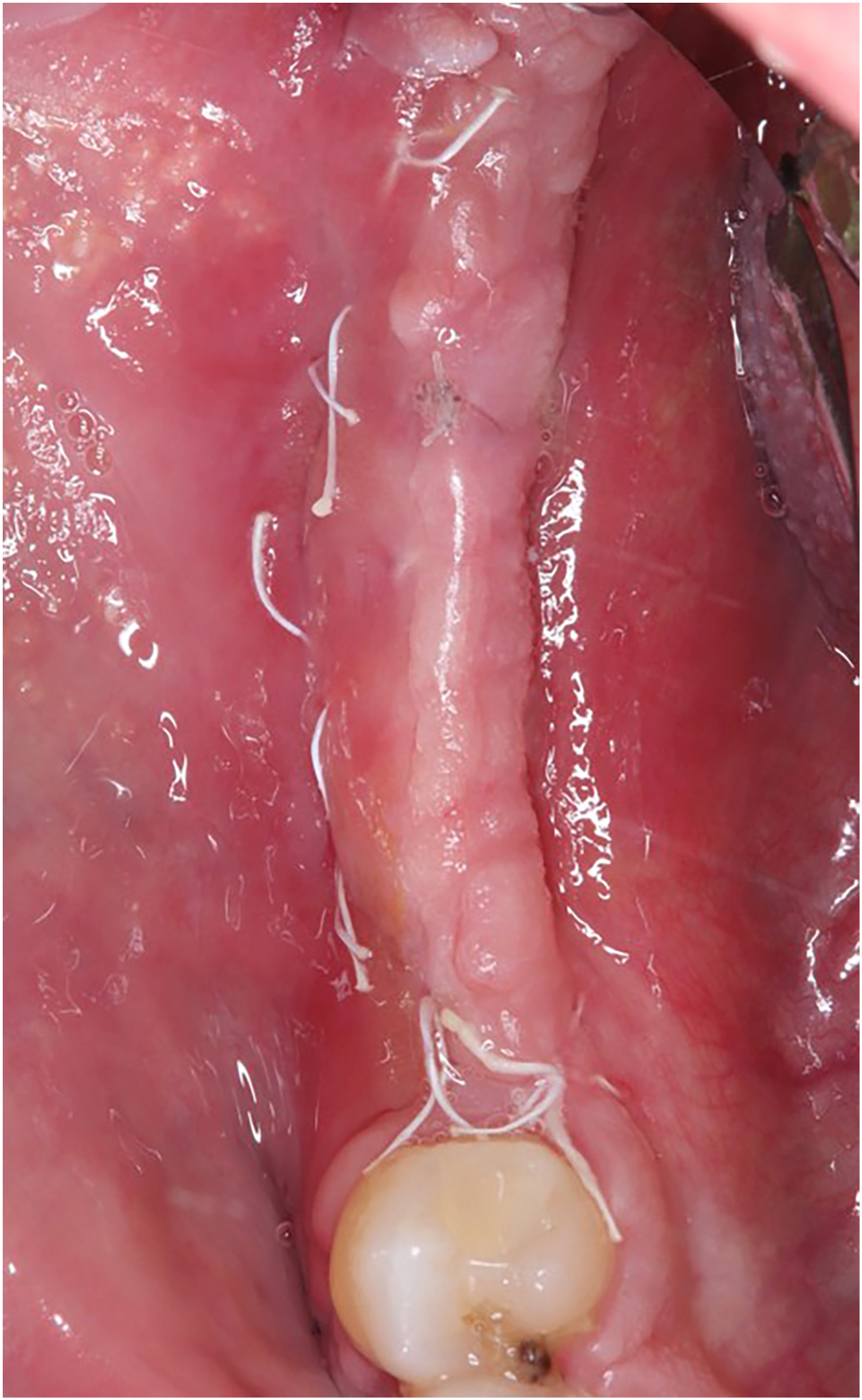 A surgical view of mandibular soft tissue with incisions at the base of the gingival flaps on the buccal and lingual aspects and sutures along the alveolar ridge.