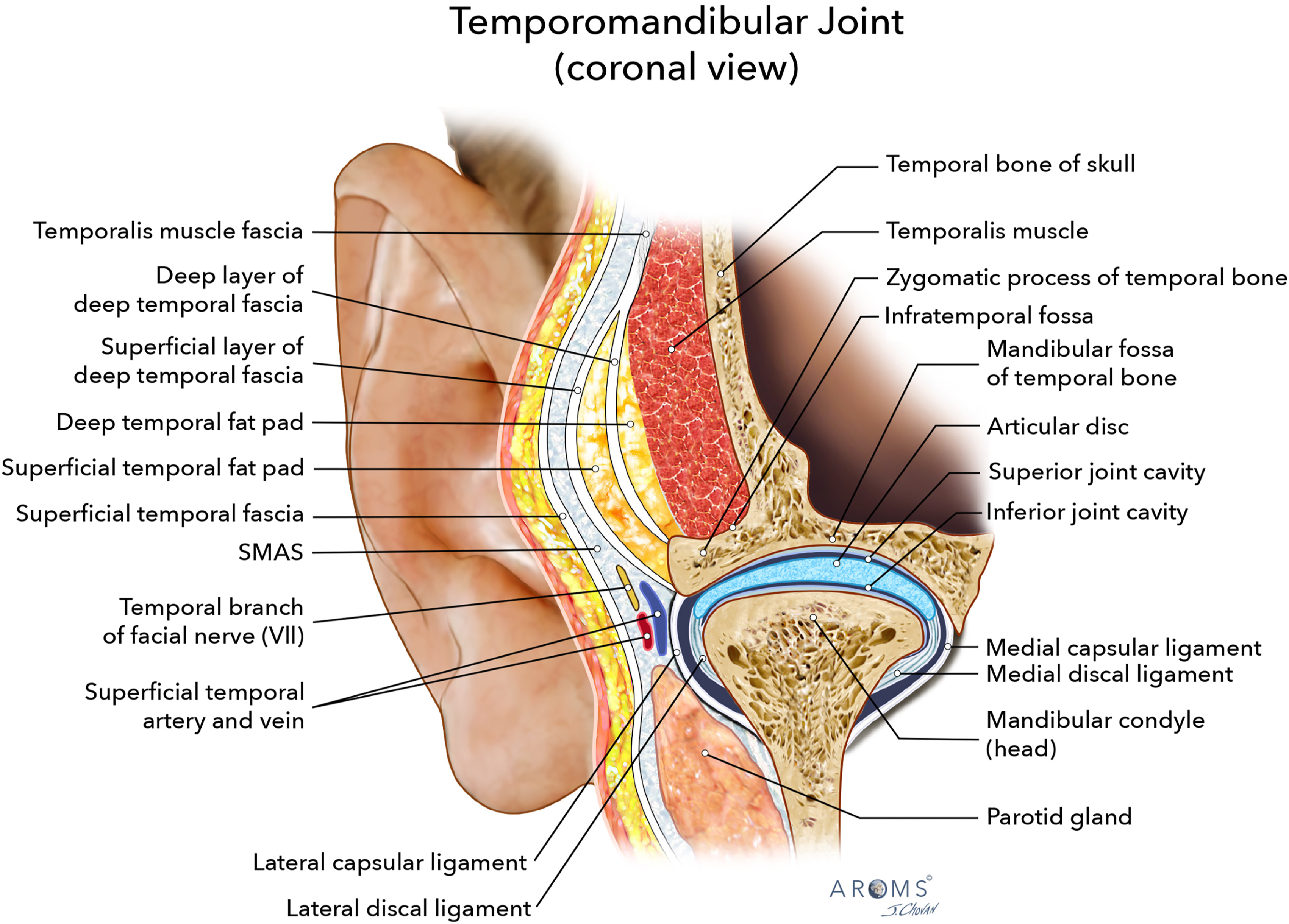 Alt text begins. An anatomical illustration of the temporomandibular joint in coronal view with labeled soft tissue structures, ligaments, muscles, and joint components. Alt text provided by Elsevier.