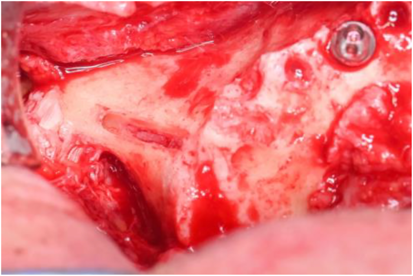 A photo of a surgical site with a thick lateral sinus wall and an implant.