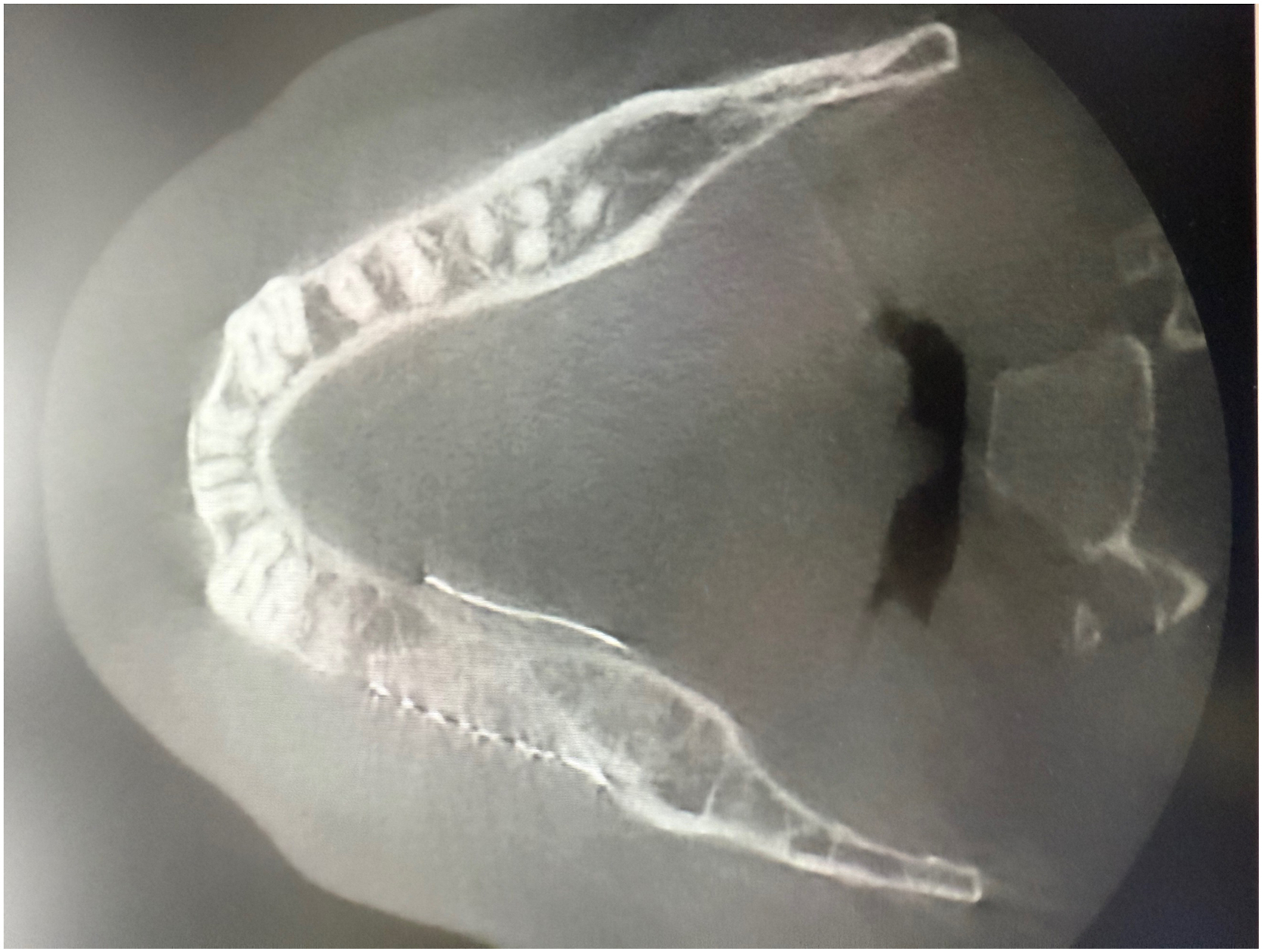 A radiographic view shows the mandible that displays dental arches and aligned suture lines along the alveolar ridge.