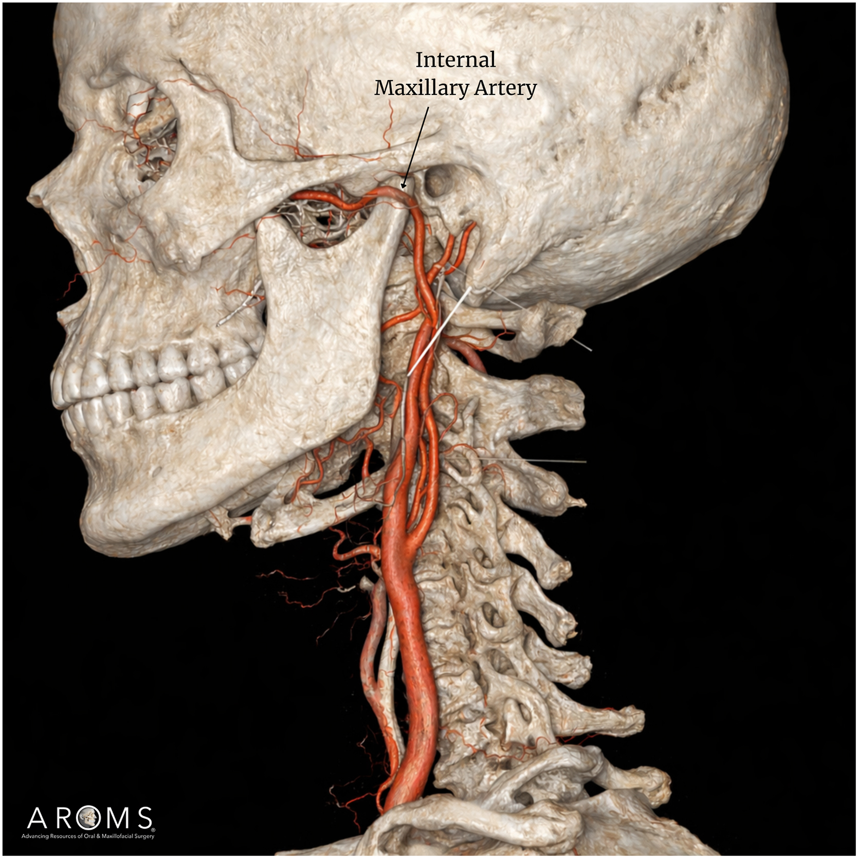 Alt text begins. A three-dimensional anatomical illustration of the skull in lateral view with the internal maxillary artery coursing adjacent to the mandibular condylar neck. Alt text provided by Elsevier.