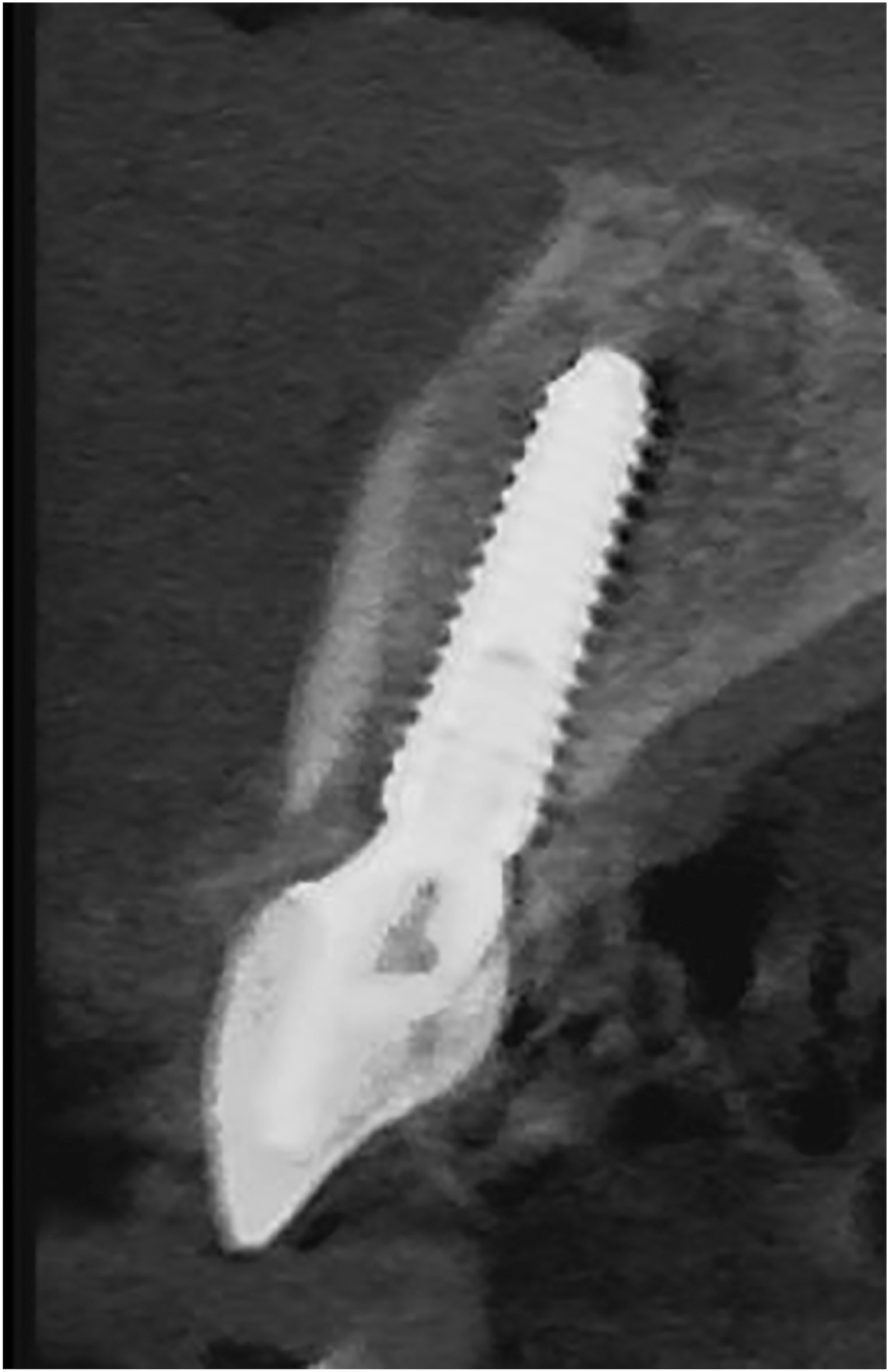A sagittal dental scan shows a screw shaped implant placed within the jawbone with a defined surrounding bone contour and a narrow space along the outer edge.