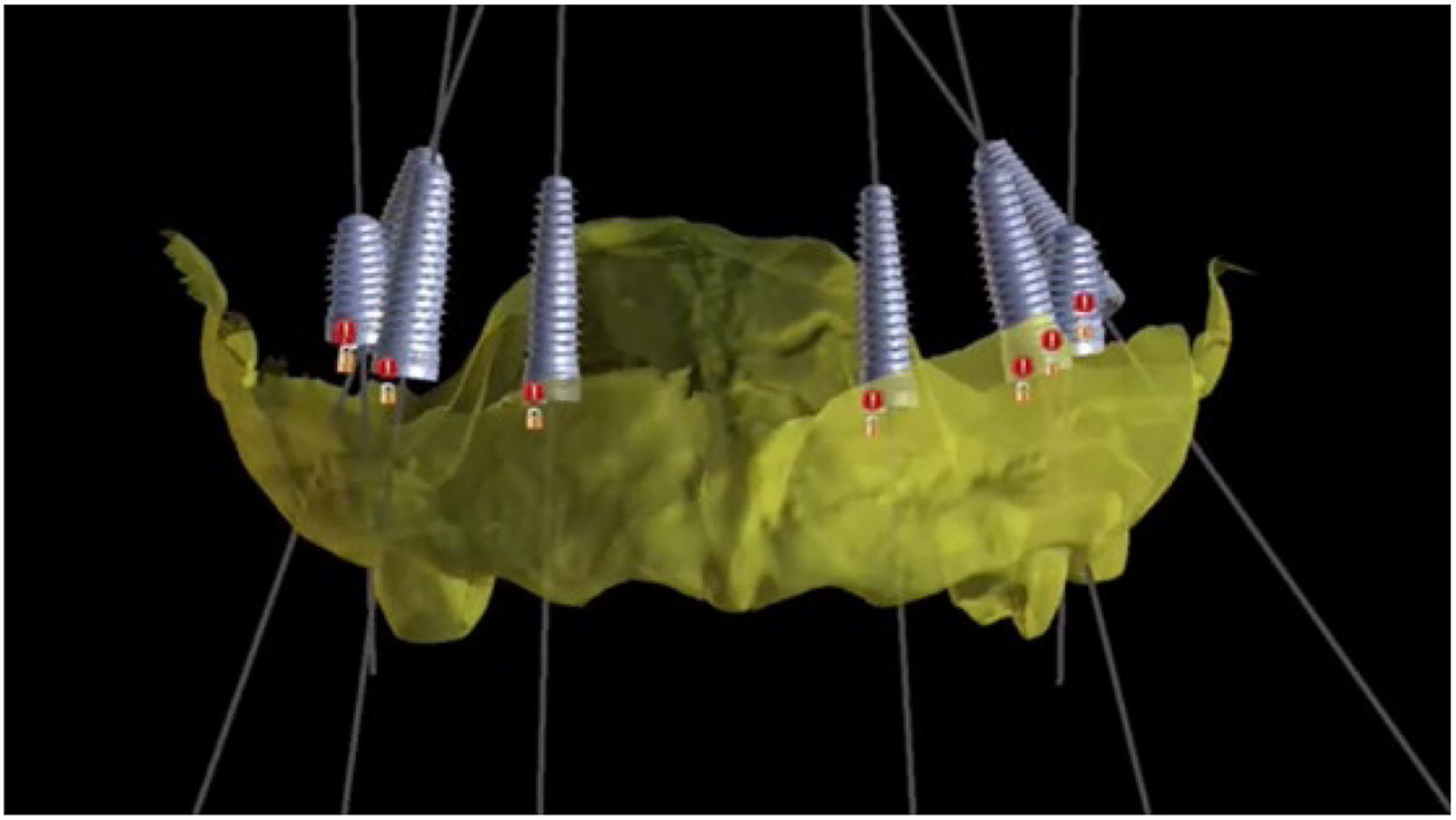 An illustration shows a jaw model with six proposed implant positions, each marked with a screw and a dark dot.