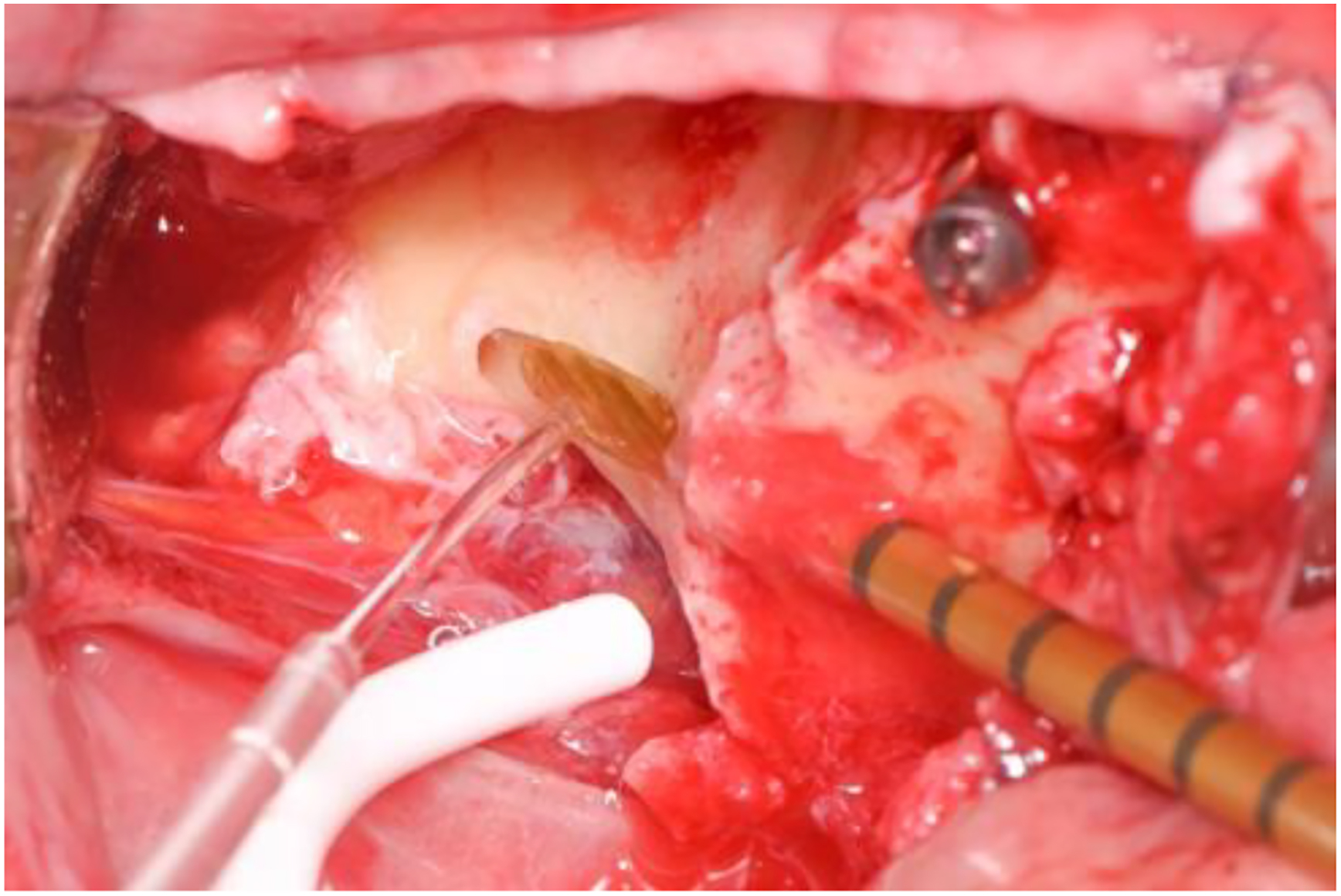 A photo of a surgical site with a Versah tip and side cutting drill carving a slot.