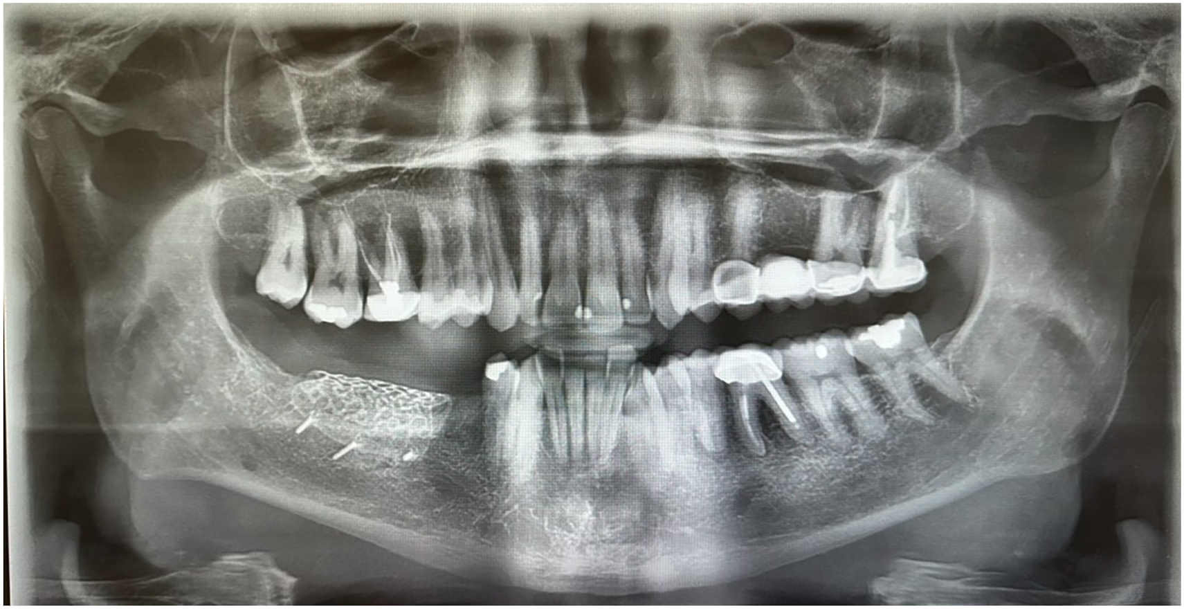 A panoramic radiograph of the mandible with a radiopaque titanium mesh and bone graft material at the left posterior region over extraction sites 29 and 32.