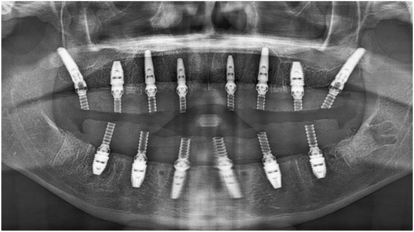 A radiographic image shows a patients upper jaw with fourteen pterygoid implants placed to eliminate a distal cantilever.