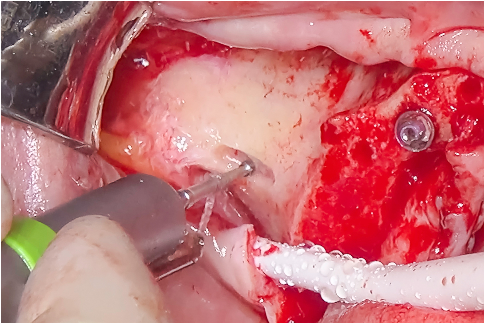 Intraoral surgical view shows round drill contacting base of cheekbone, rotating tip engaging bone surface, irrigation tubing adjacent, and implant site preparation underway.