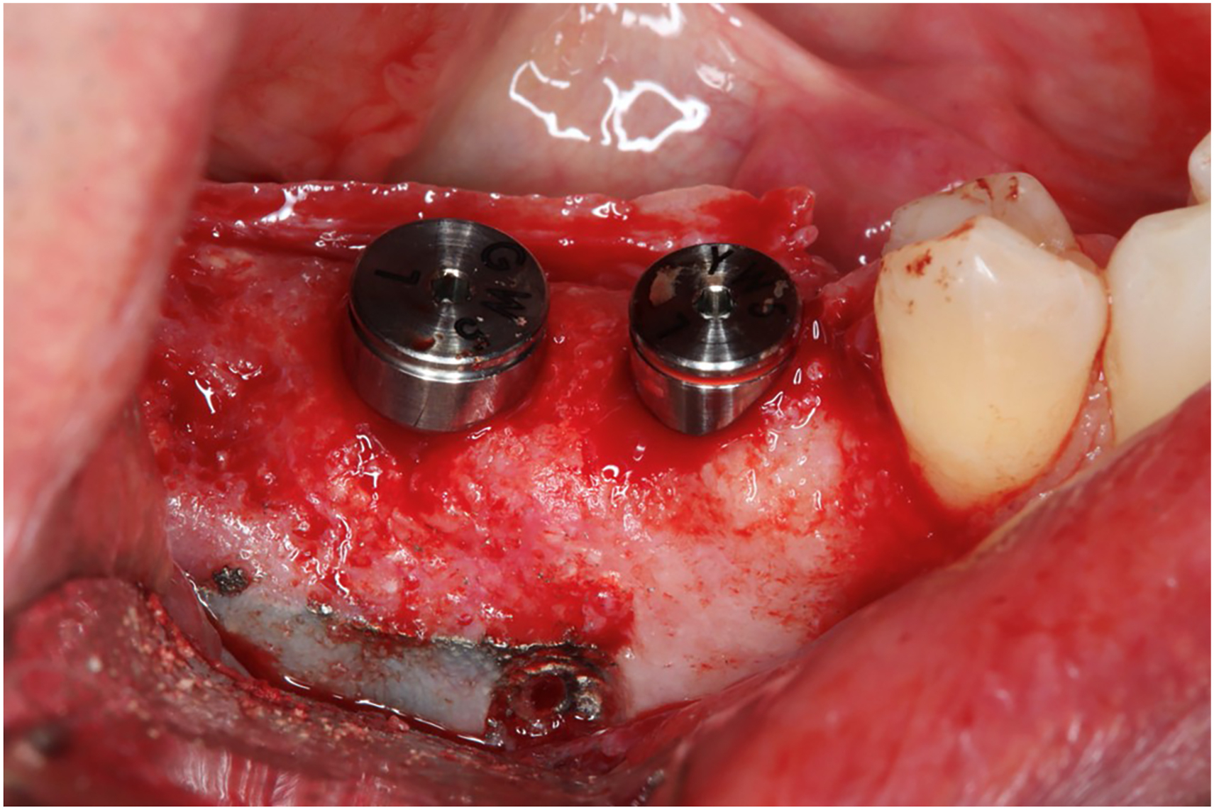 A surgical view of the mandibular left posterior region with two dental implants and healing abutments with surrounding soft tissue at two weeks postoperative.