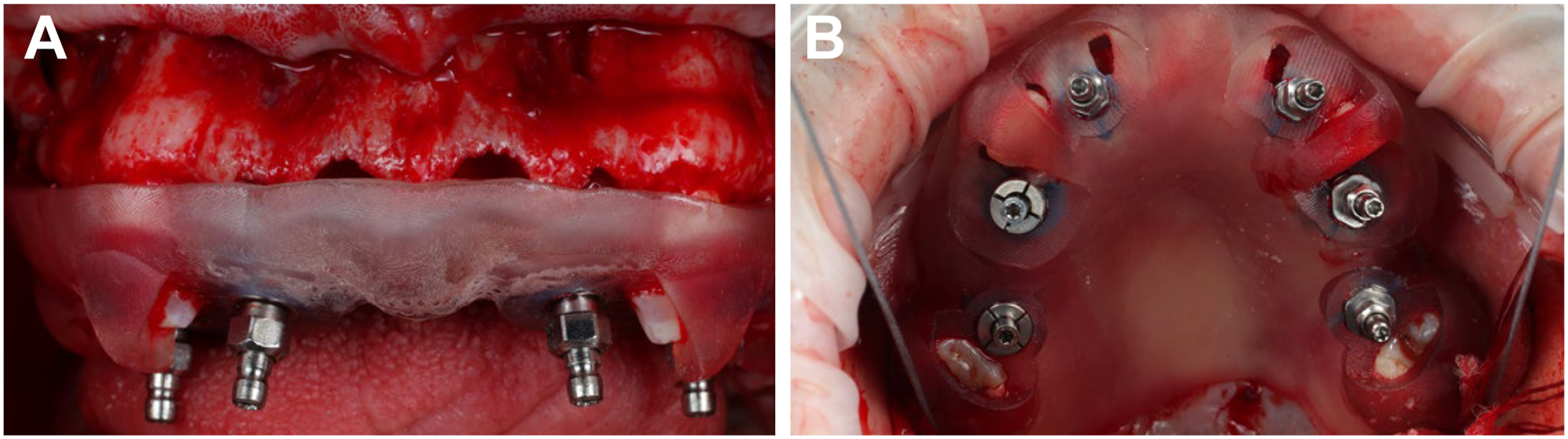A clinical photo shows two views: one with a jaw and four implants under a guide, the other with eight implants in an open mouth.