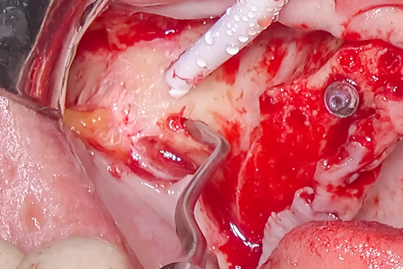 A photo of a surgical site with an F I B I-1 Sinus Elevator.