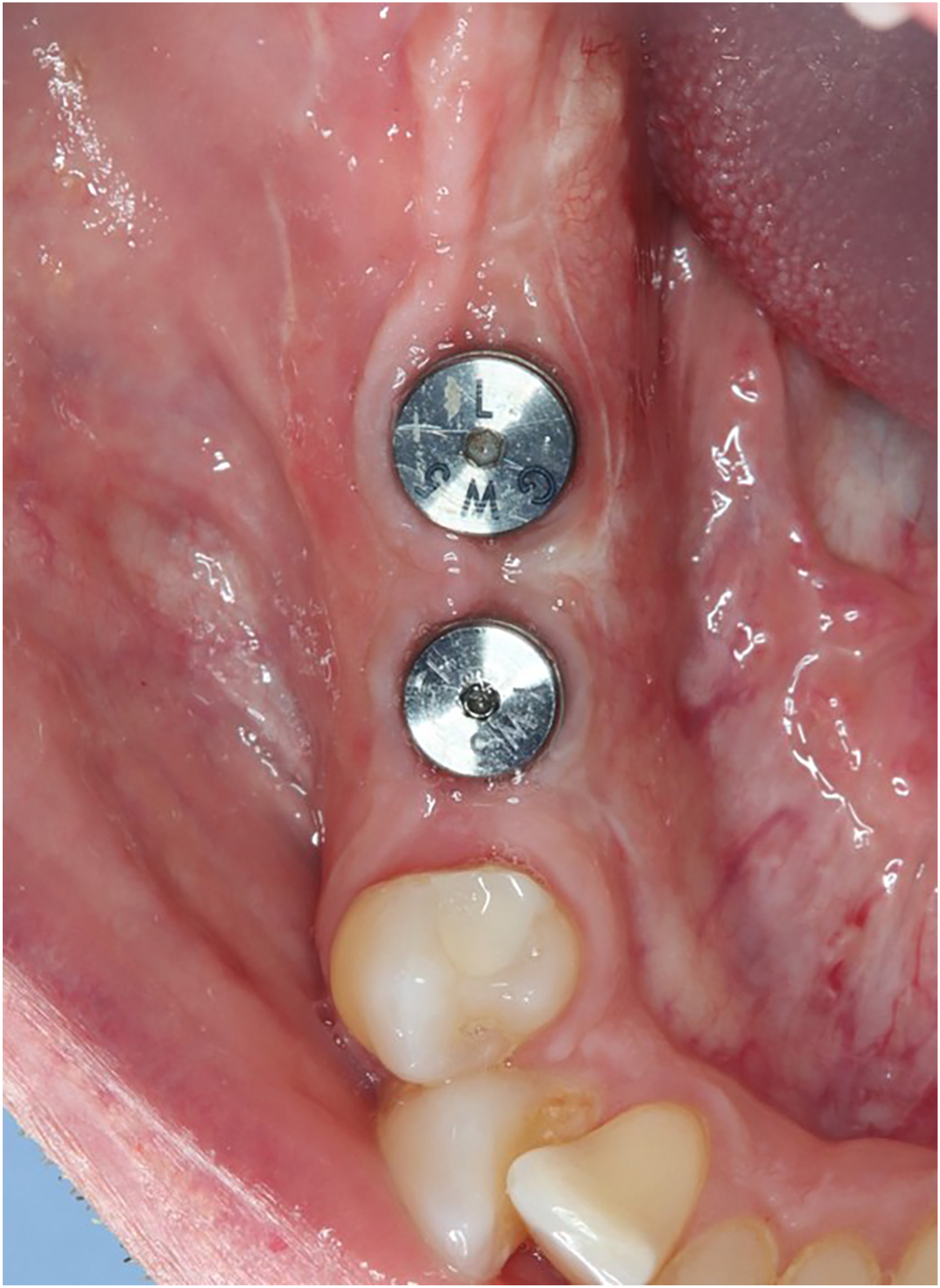 An intraoral photograph of the mandibular left posterior region with two dental implants and healing abutments at five months postoperative with healed gingival tissue.