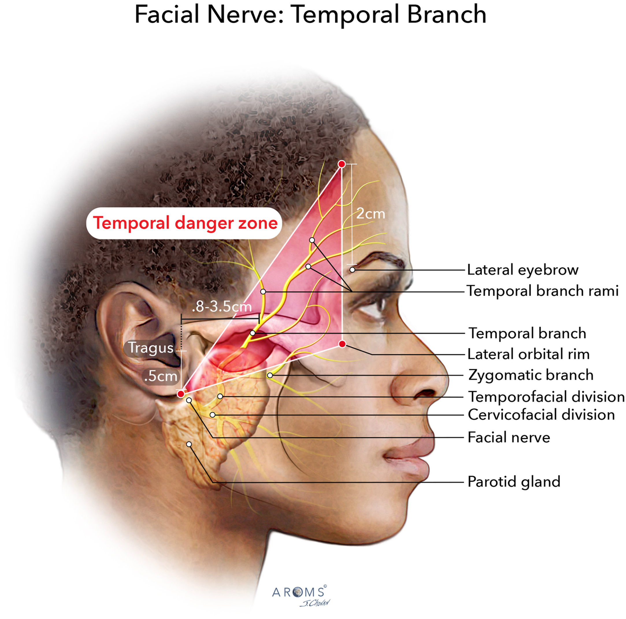 Alt text begins. An anatomical illustration of the lateral face with labeled temporal branch of the facial nerve, adjacent branches, and a defined temporal danger zone. Alt text provided by Elsevier.