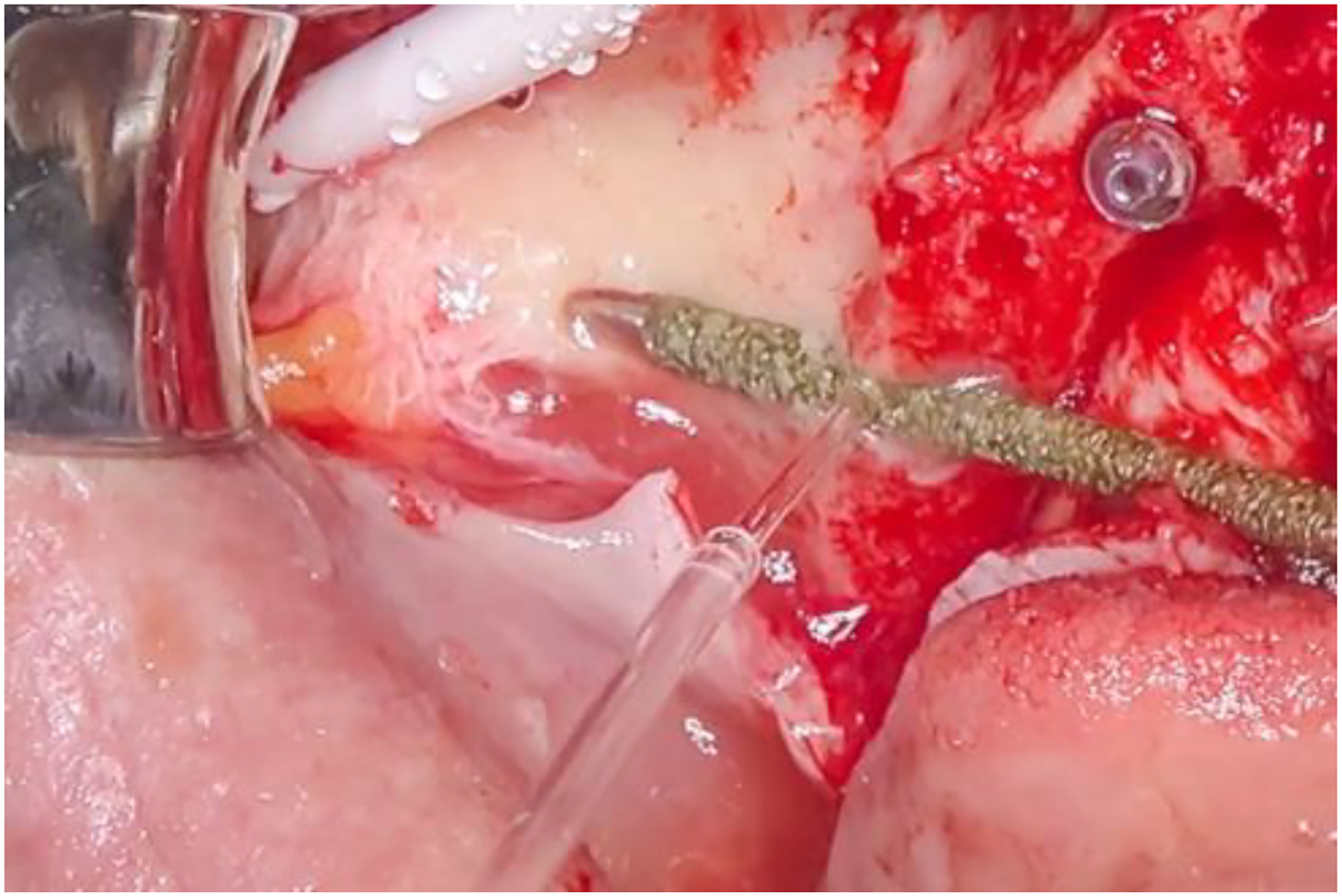 A photo of a surgical site with an A N D O side-cutting drill defining a slot.