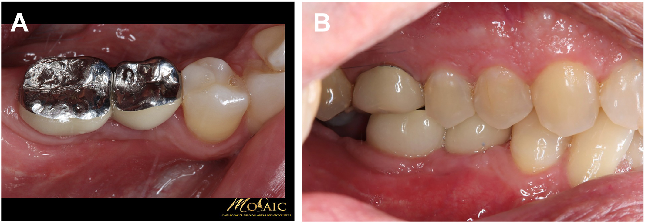 A set of two intraoral views shows restored molar teeth with metallic and ceramic crowns before implant placement.