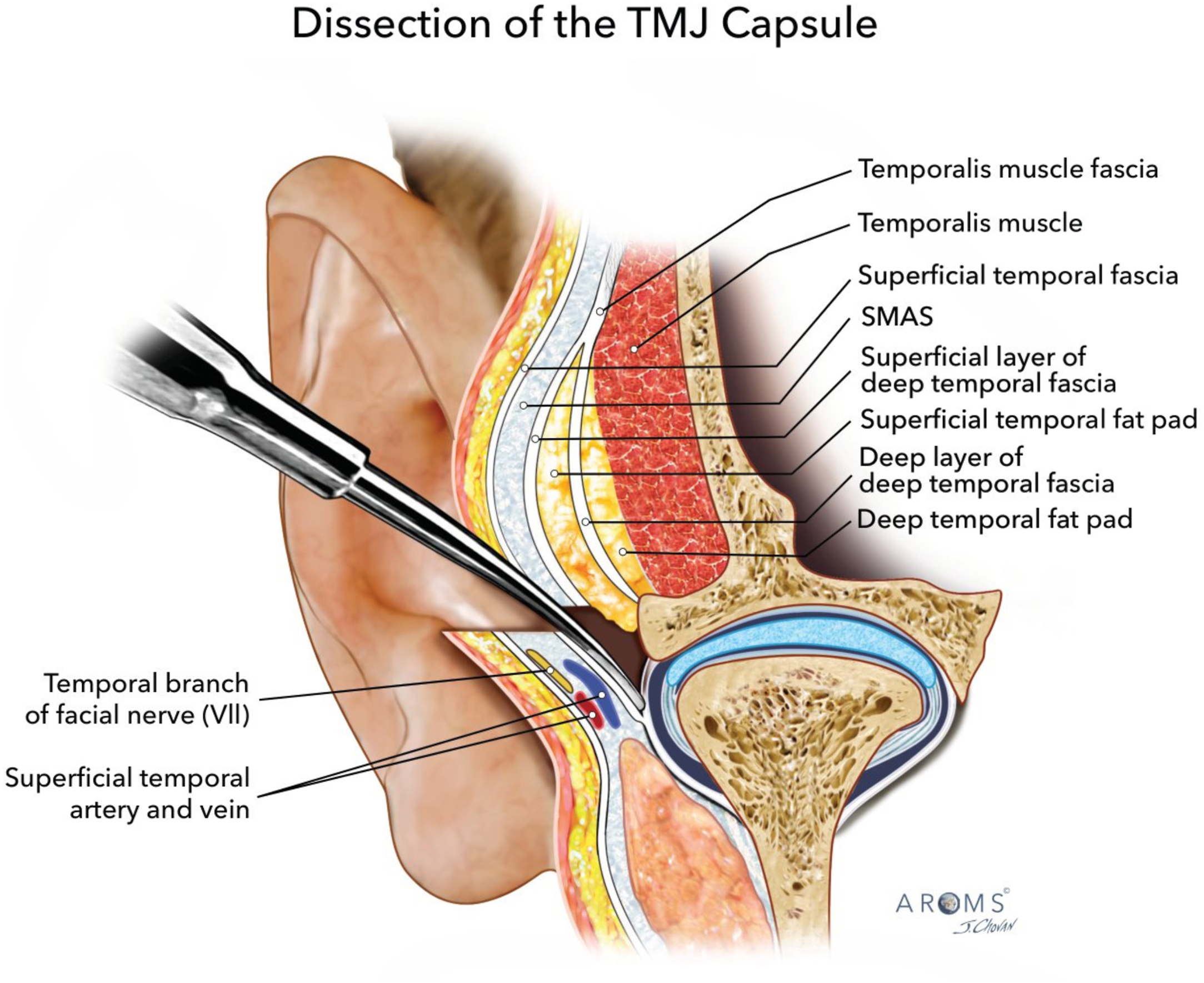 Alt text begins. An anatomical illustration of the temporomandibular joint in lateral view with layered dissection of soft tissues and labeled surgical instruments near the capsule. Alt text provided by Elsevier.