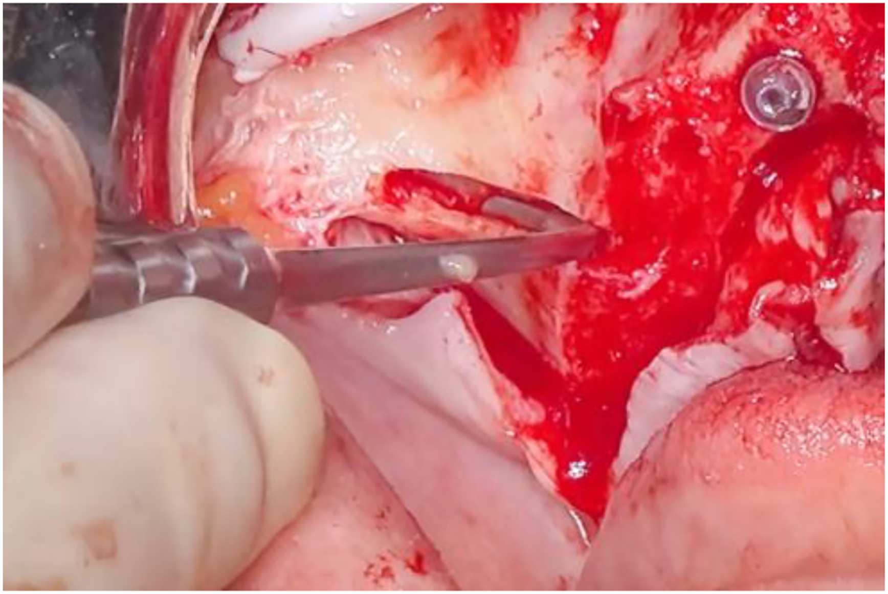 A photo of a surgical site with an F I B I-1 Sinus Elevator, long curved side.