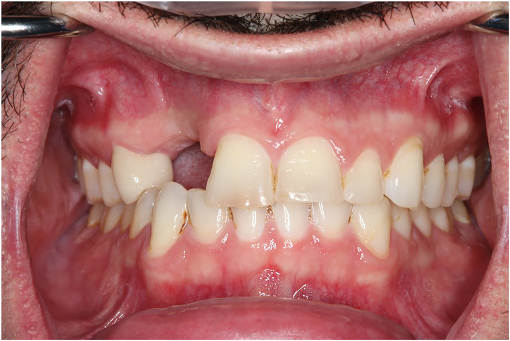 A frontal intraoral view of the maxillary and mandibular arches with missing teeth in the posterior regions and anterior spacing with retractors holding the lips and cheeks.