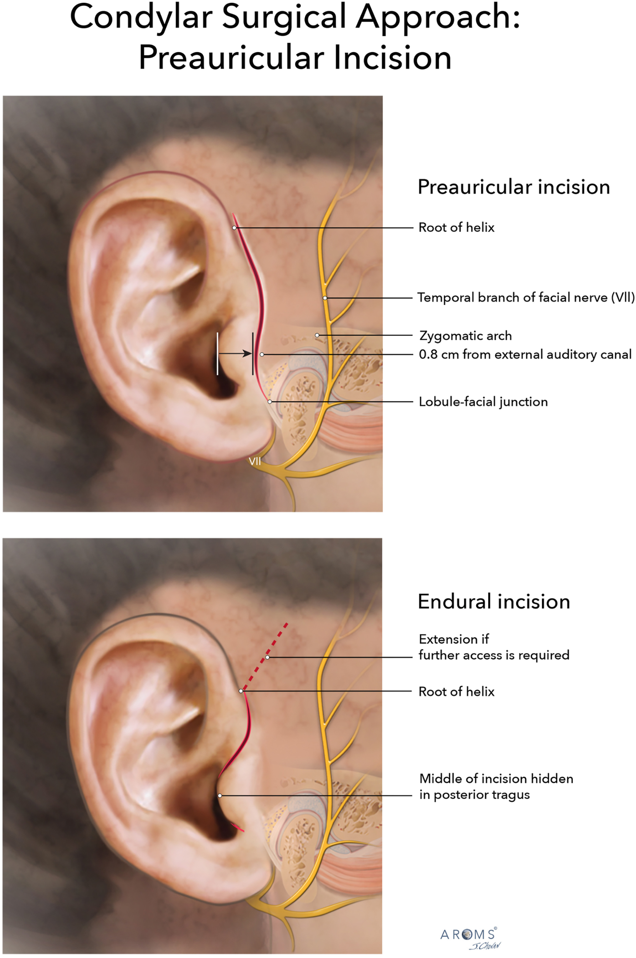 Alt text begins. An anatomical illustration with two panels of the lateral ear depicts preauricular and endaural incision designs with labeled landmarks and nerve branches. Alt text provided by Elsevier.