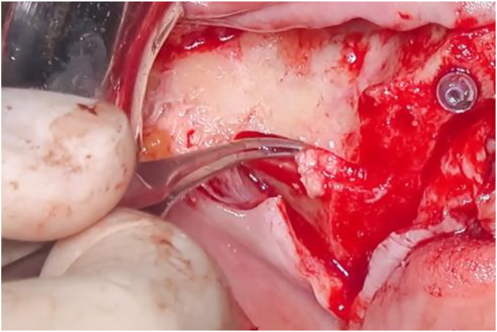 A photo of a surgical site with BioOss Collagen as a thin layer along a slot.