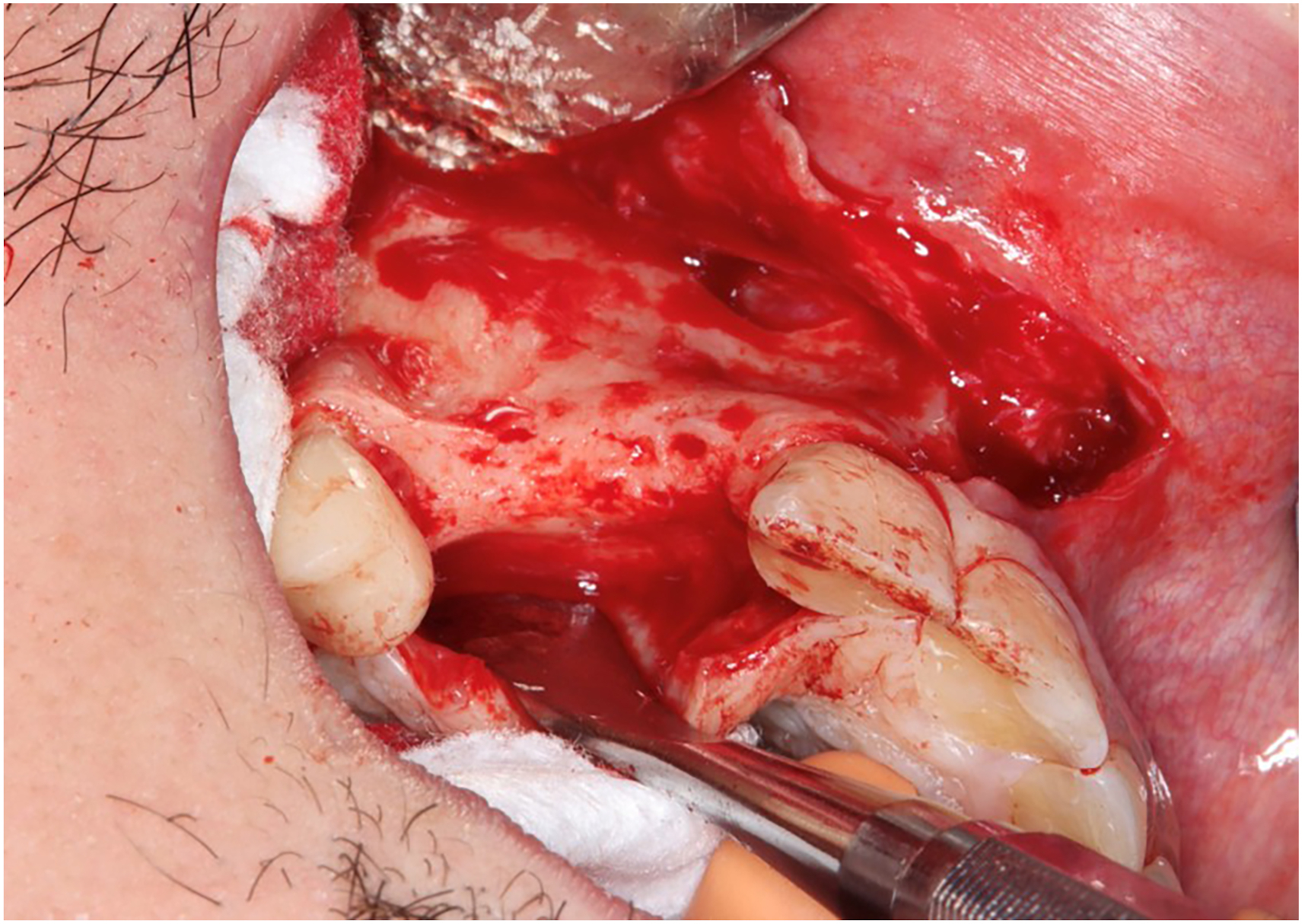 A surgical view of the mandibular left posterior region with an osteotomy site and surgical instruments exposing the alveolar bone with retracted soft tissue.