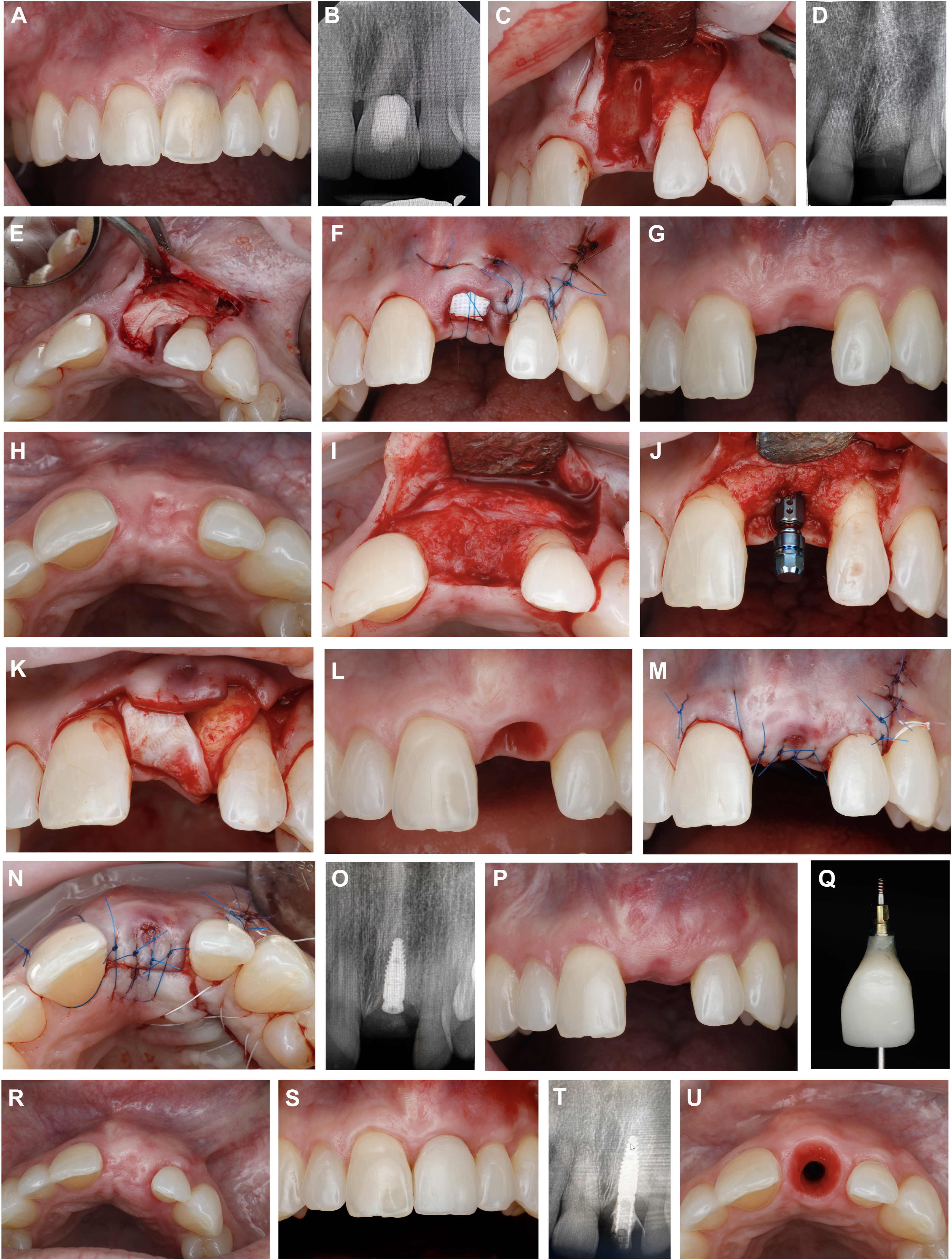 A multi-panel clinical photos show the extraction of a front tooth, bone grafting, implant placement, and soft tissue refinement over two years.