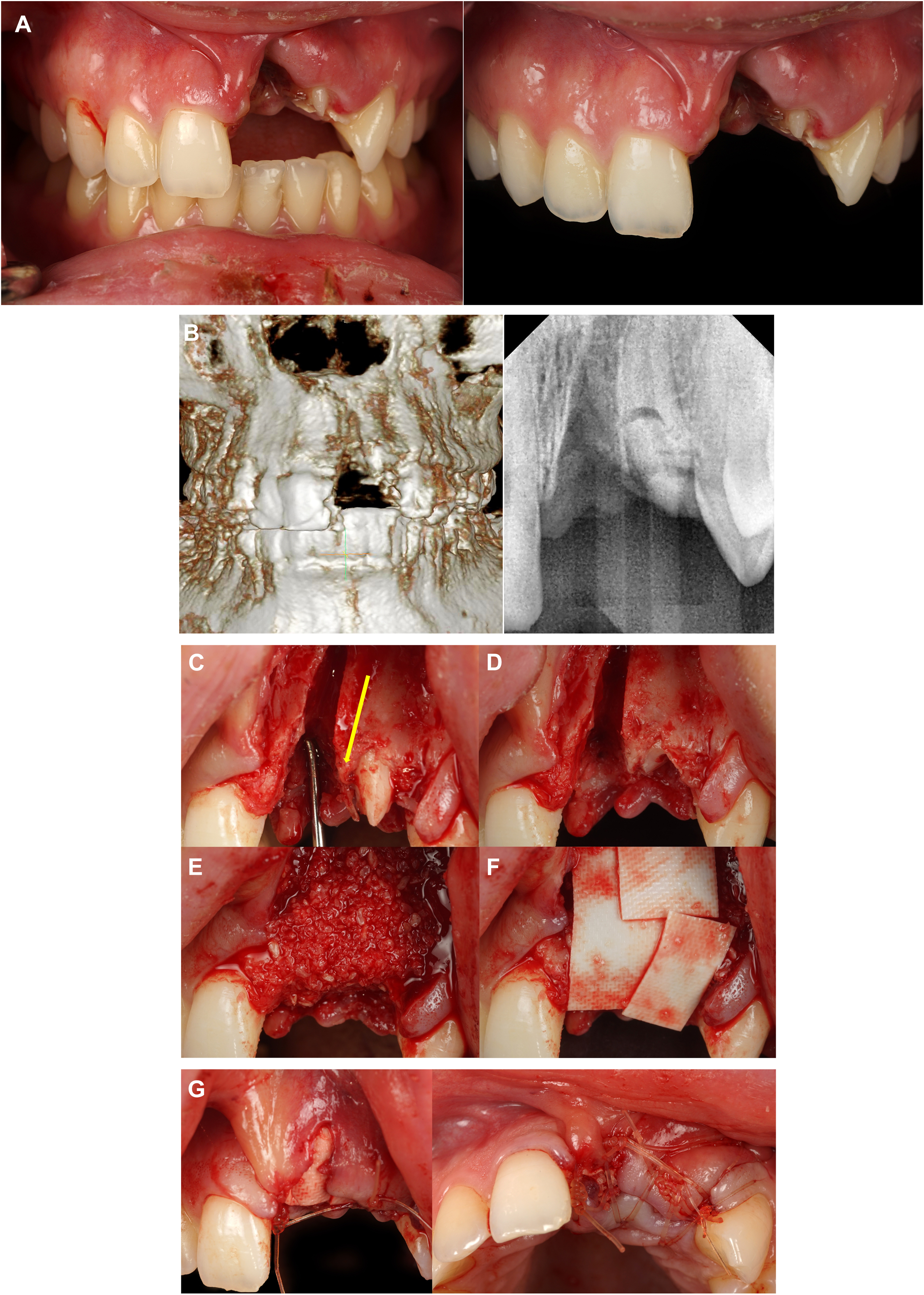 A multi-panel dental photo, radiographs, and C T show the repair of a severe tooth injury, including bone grafts, an implant, and a final restoration.