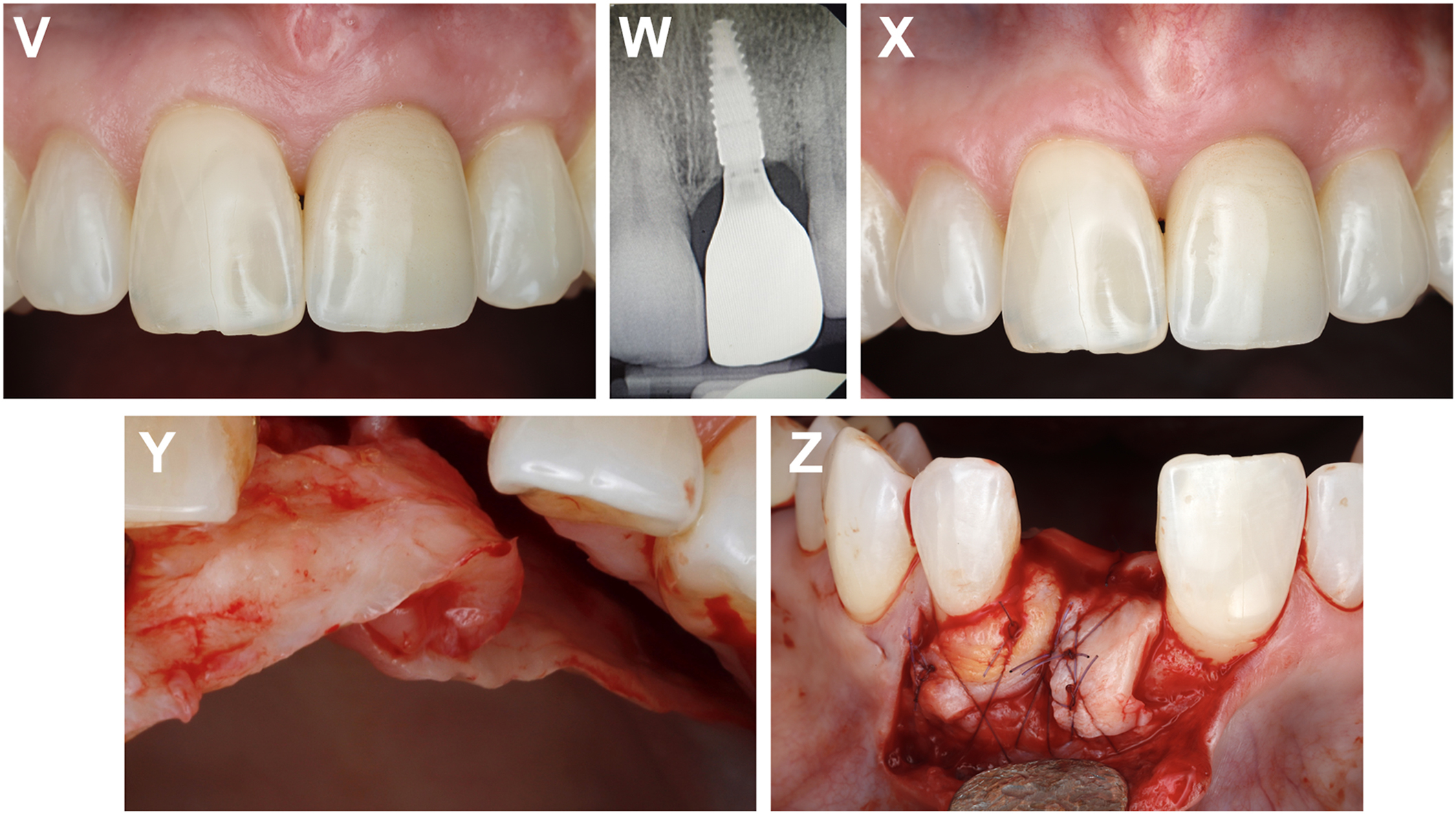 A multi-panel clinical photos show the extraction of a front tooth, bone grafting, implant placement, and soft tissue refinement over two years.