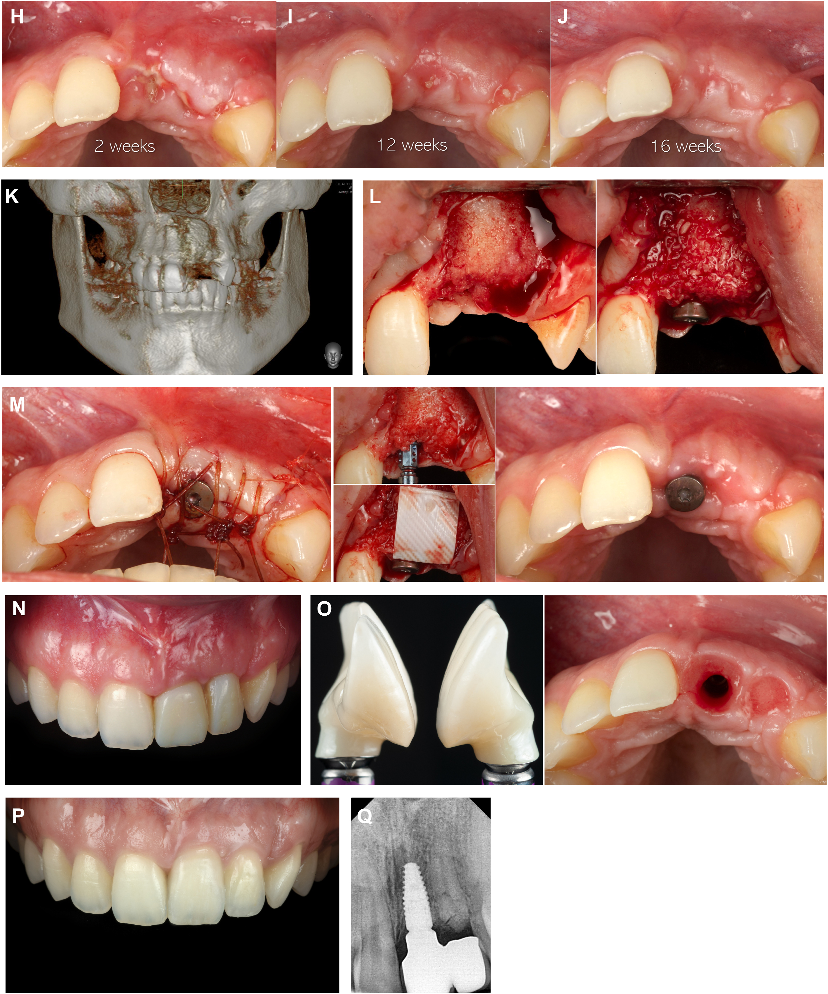 A multi-panel dental photo, radiographs, and C T show the repair of a severe tooth injury, including bone grafts, an implant, and a final restoration.