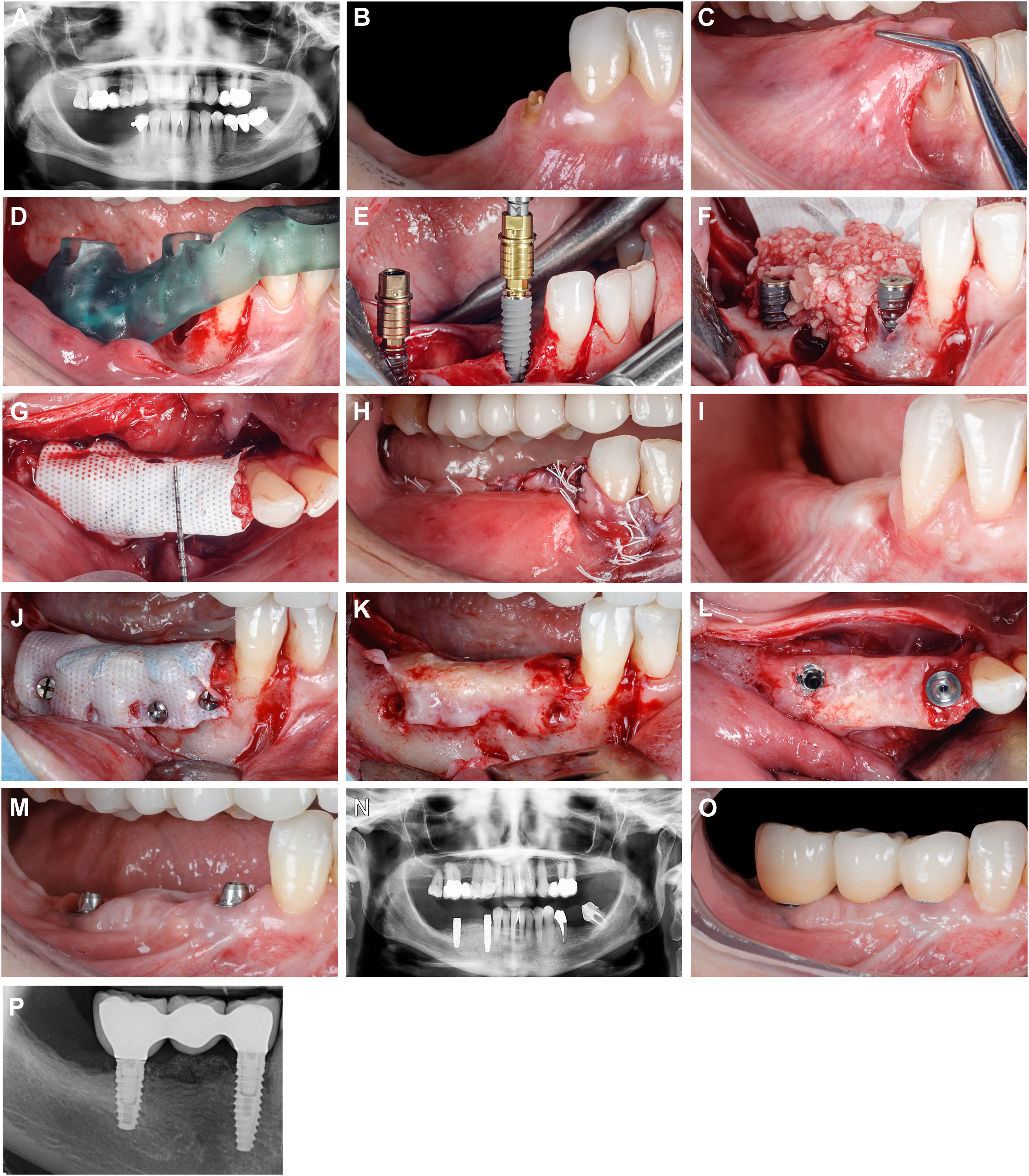 Three radiographic images and 13 clinical photos show a jaw with teeth, tools, implants, a perforated membrane, an autogenous bone mixture, fixation tacks, sutures, and multi-unit abutments.