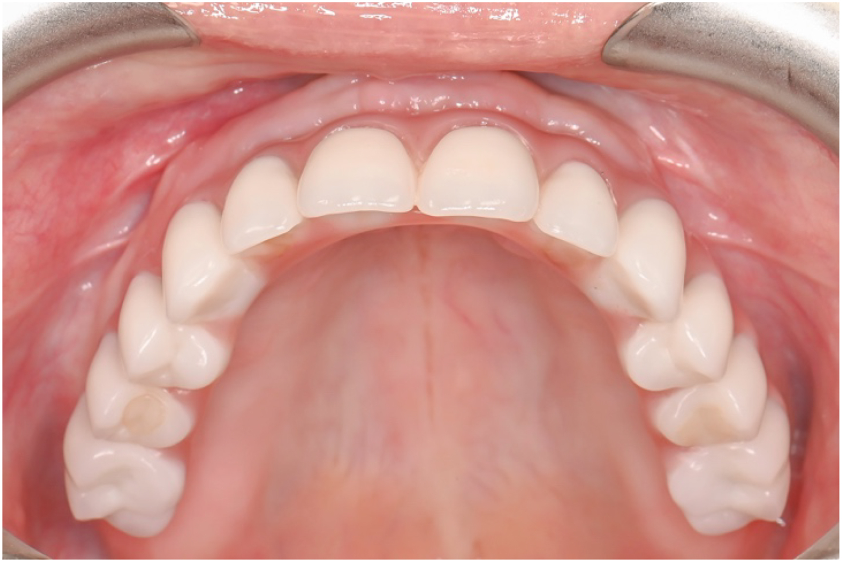 A photo of a mouth with healthy teeth and thin restoration from left to right.