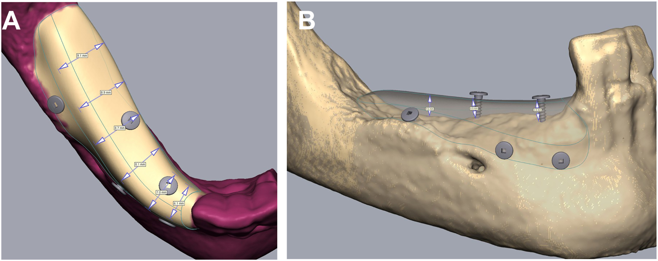 A schematic of customized mandibular mesh design with planned horizontal and vertical bone gain, labeled a and b, with measurement markers and screw placement sites along the alveolar ridge.
