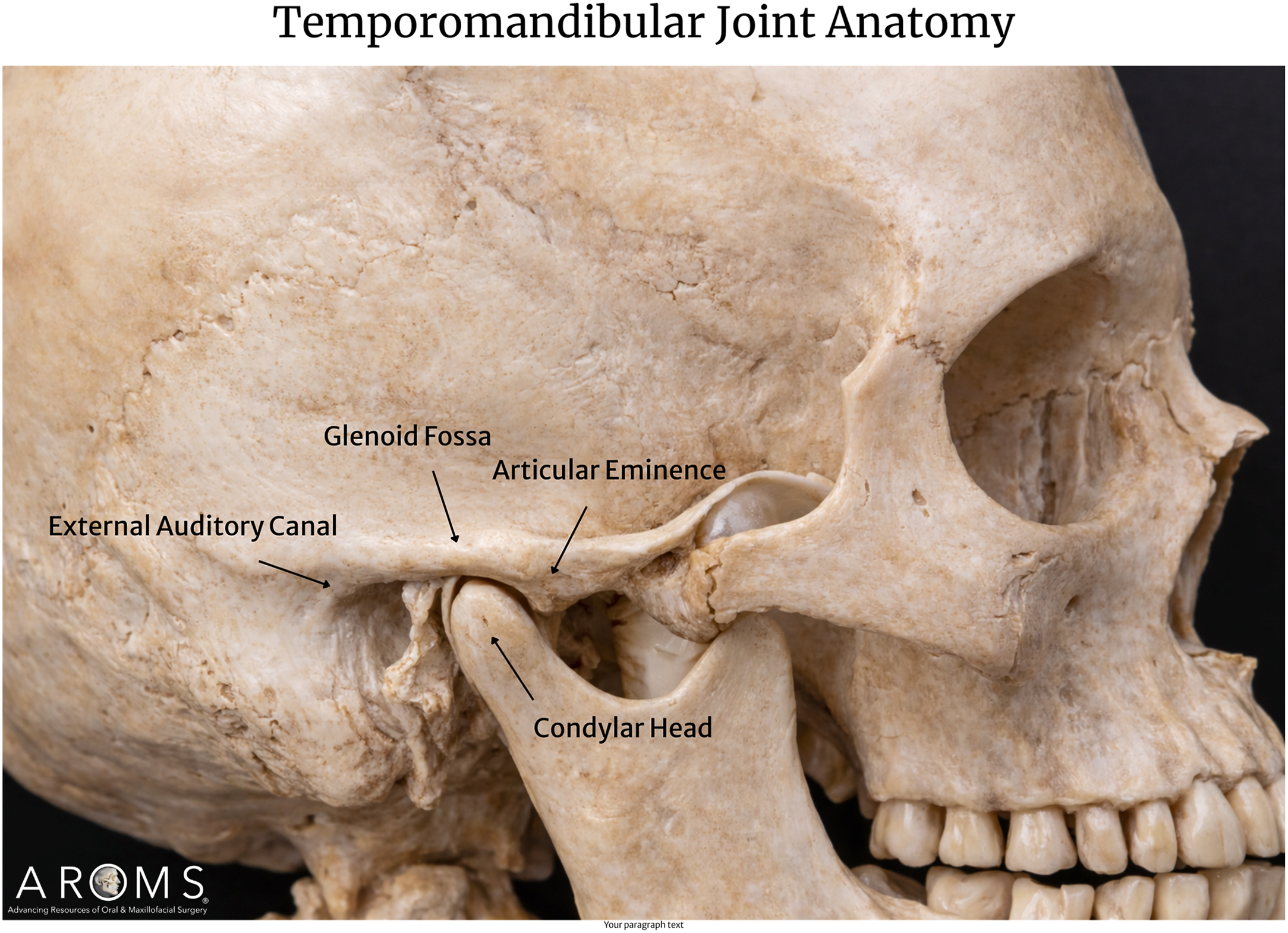 Alt text begins. A photograph of a skull in lateral view highlighting temporomandibular joint osseous anatomy with labeled glenoid fossa, articular eminence, condylar head, and external auditory canal. Alt text provided by Elsevier.