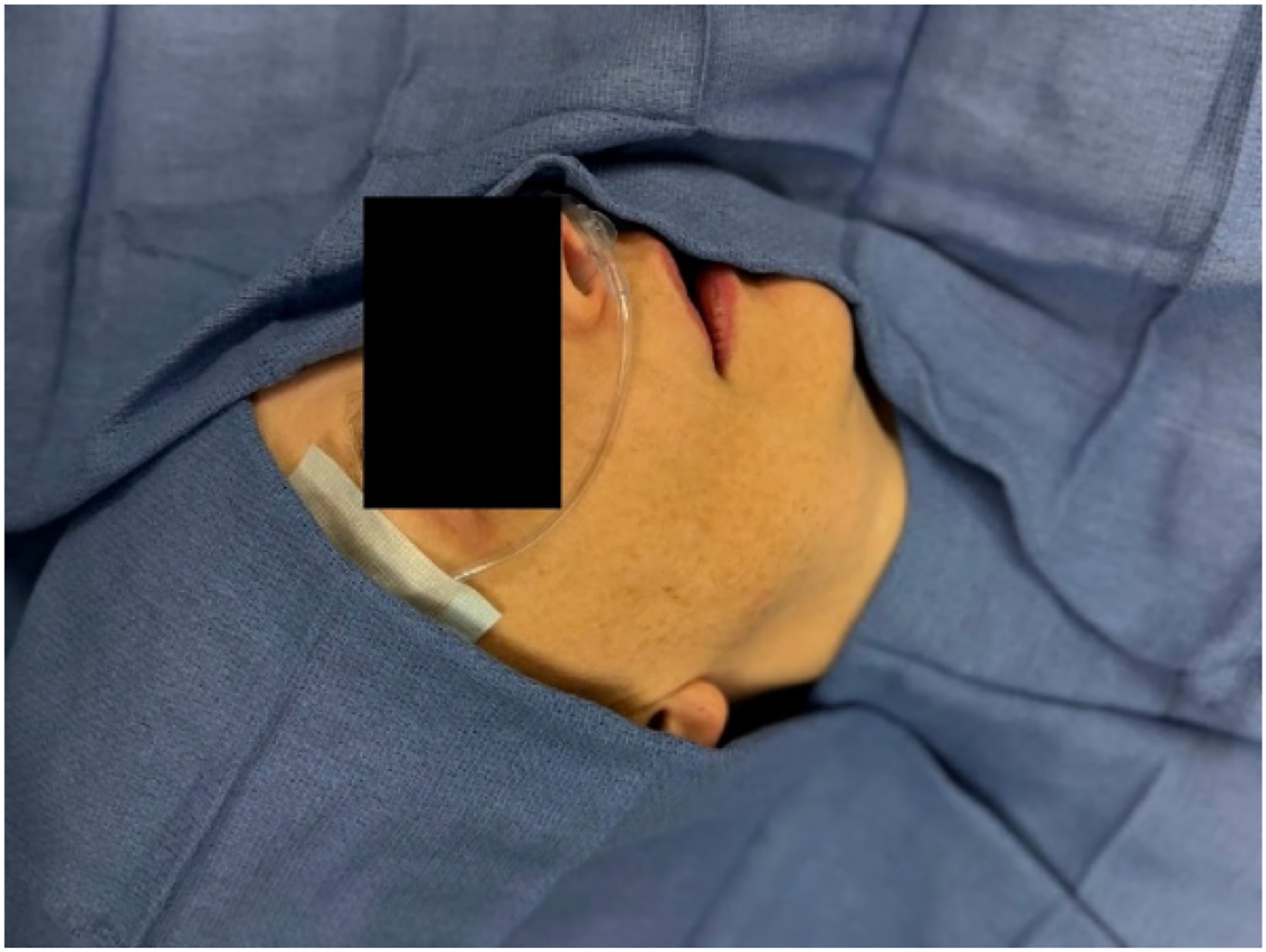 Alt text begins. A photograph depicts a sedated patient covered with surgical drapes and a nasal cannula taped across the cheek beneath the nose. Alt text provided by Elsevier.