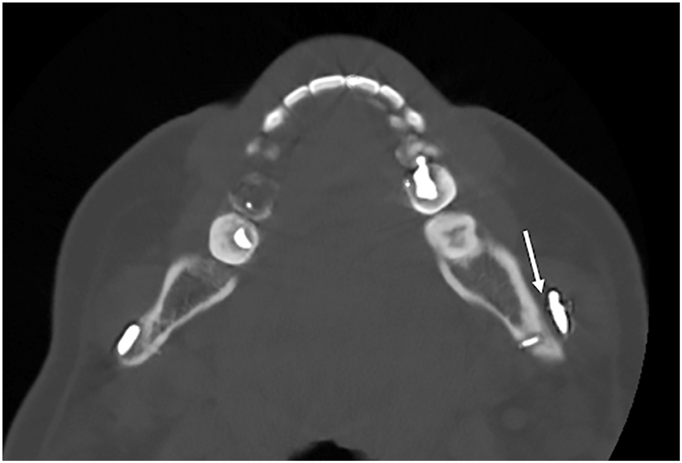 Alt text begins. A computed tomography scan shows a left temporomandibular joint prosthesis with a screw fracture and displacement with a visible gap pointed to by an arrow. Alt text provided by Elsevier.