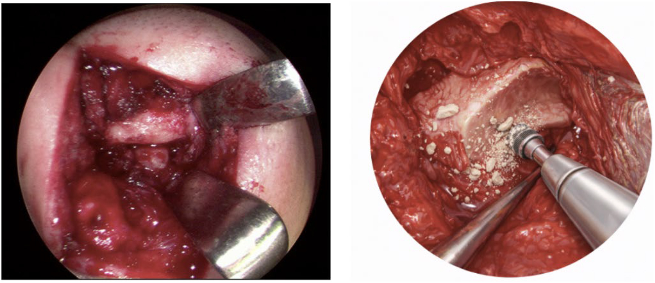 Alt text begins. A two-panel intraoperative photo demonstrates the inspection and conservative contouring of the superior joint space during an open temporomandibular joint arthroplasty procedure. Alt text provided by Elsevier.