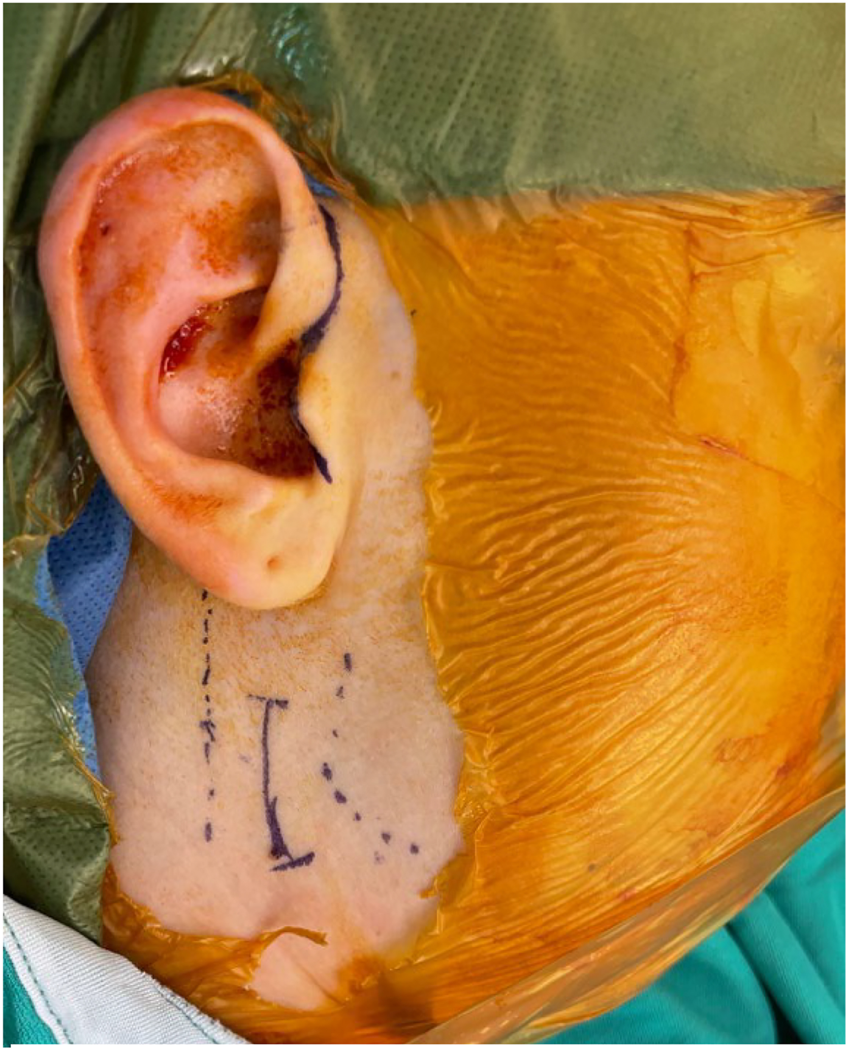 Alt text begins. A clinical photograph shows an isolated surgical field with an Ioban dressing and marked endaural and modified submandibular incision sites. Alt text provided by Elsevier.