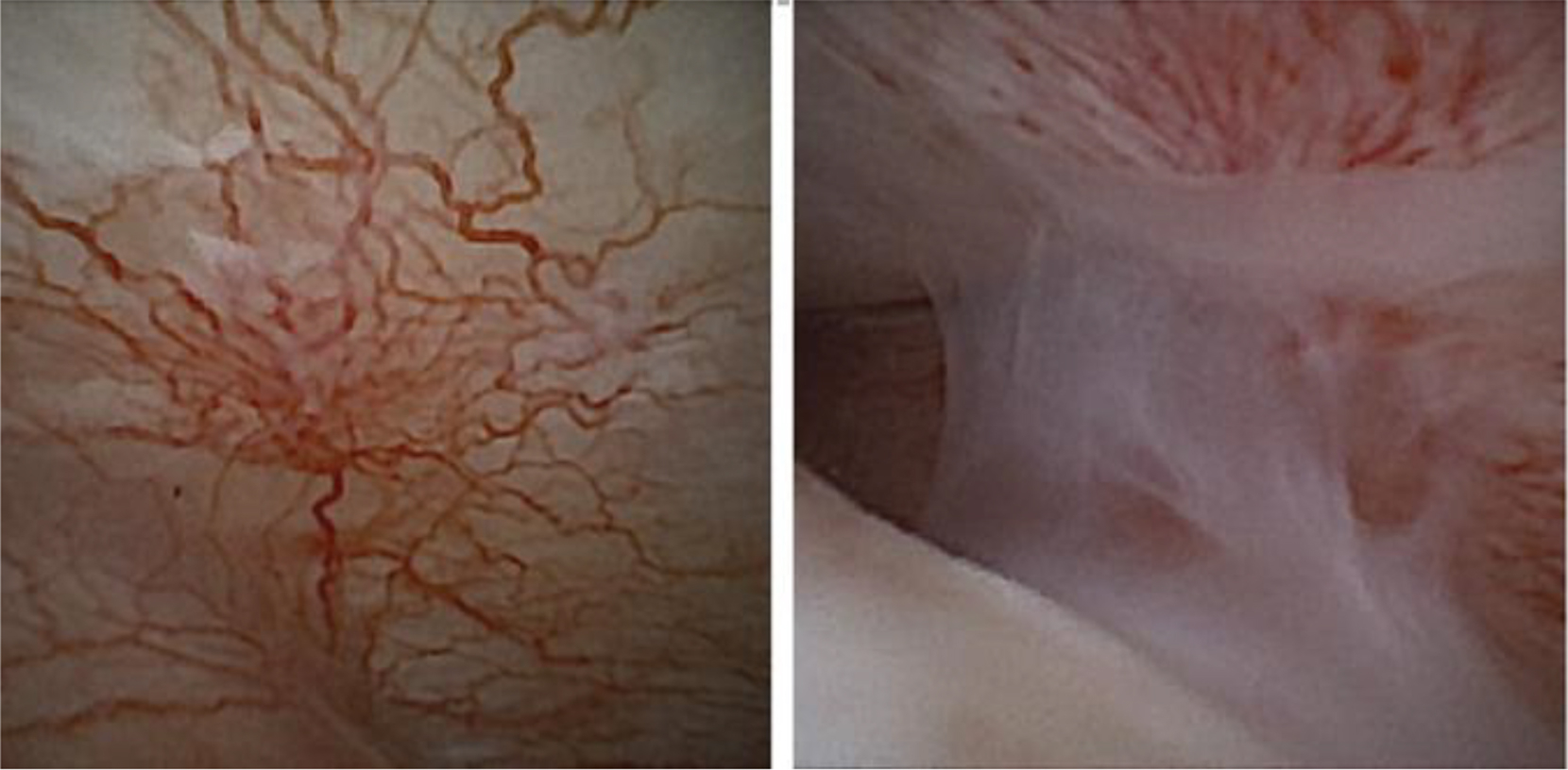 Alt text begins. A two-view arthroscopic image from a zero-degree disposable scope shows vascular synovium and pale intra-articular soft tissue. Alt text provided by Elsevier.