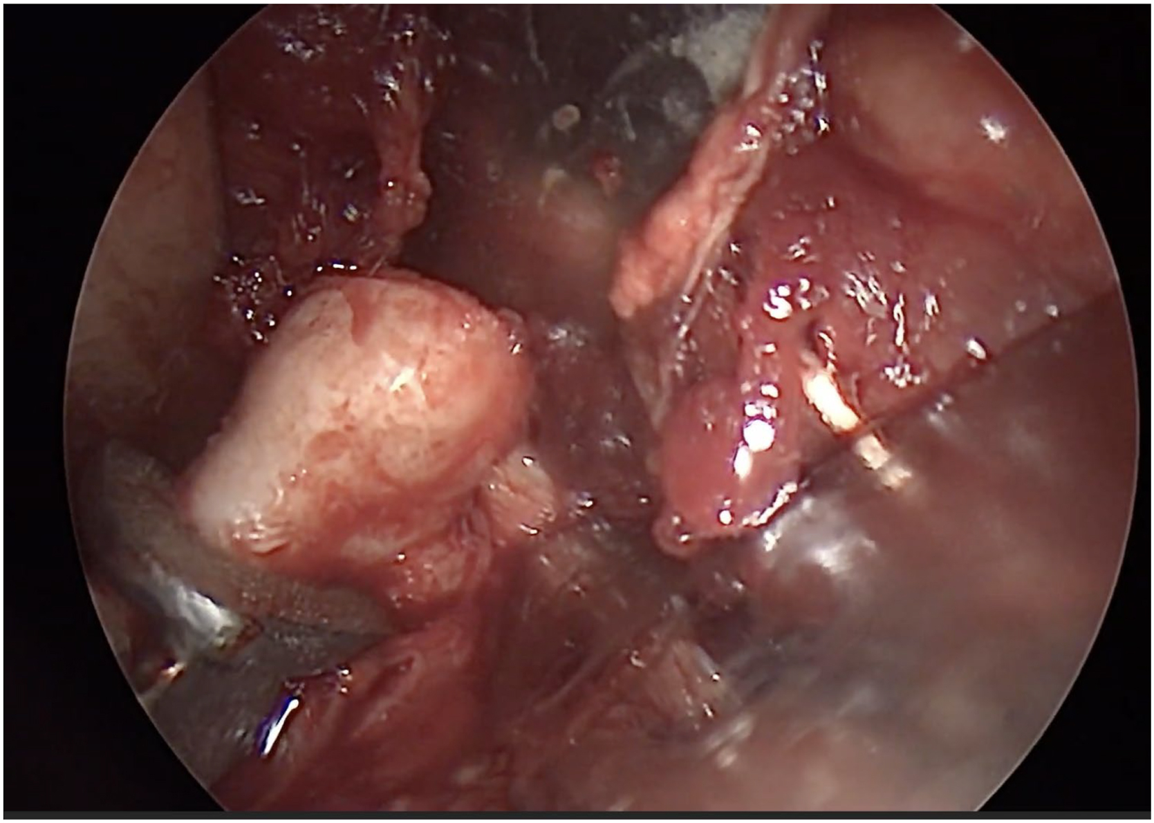 Alt text begins. An endoscopic intraoral surgical view shows access to a proportional right temporomandibular joint condylectomy using bone-borne surgical guides. Alt text provided by Elsevier.