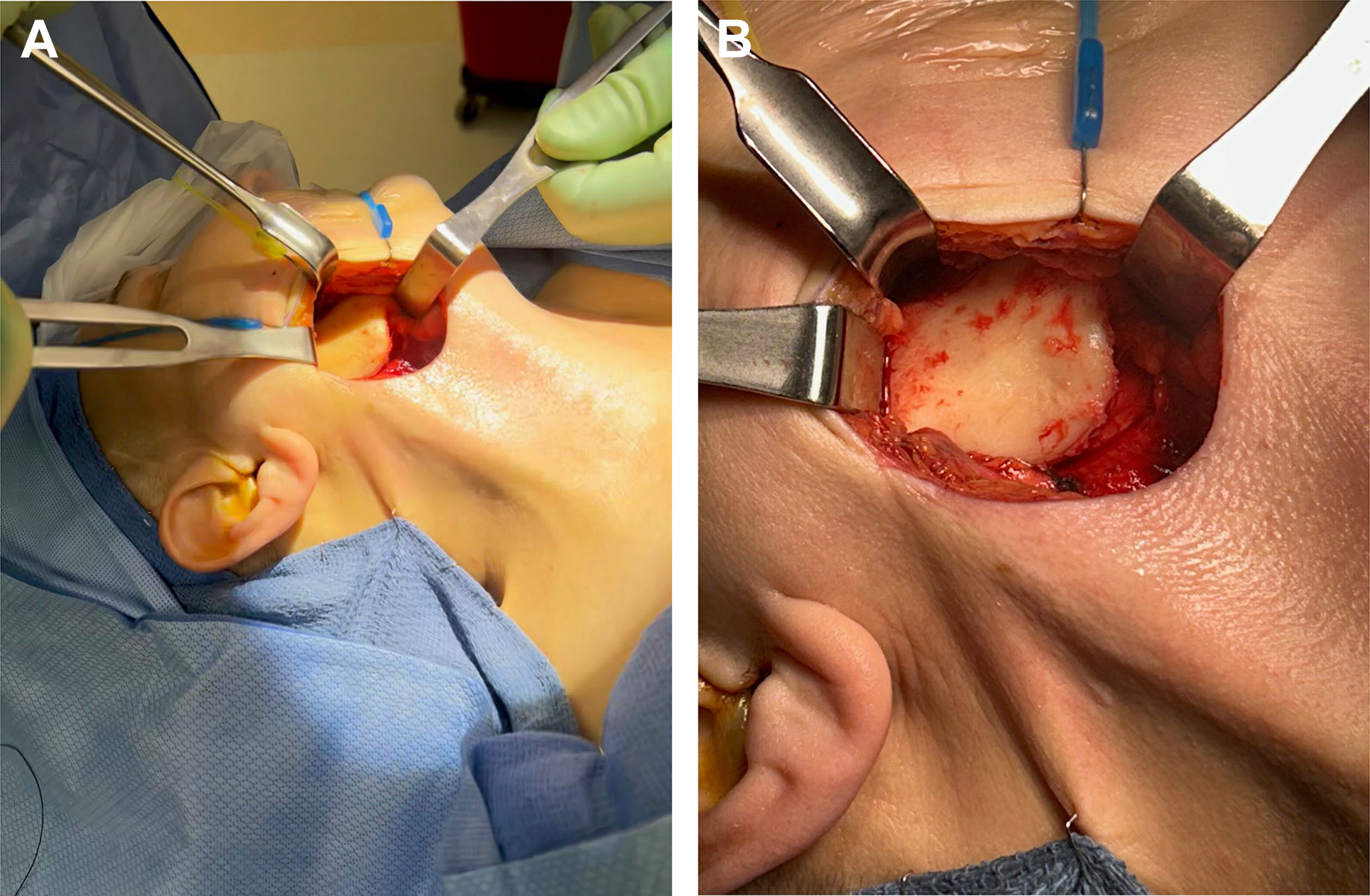 Alt text begins. A two-panel intraoperative photograph shows modified submandibular exposure and right ramus exposure through a submandibular incision. Alt text provided by Elsevier.