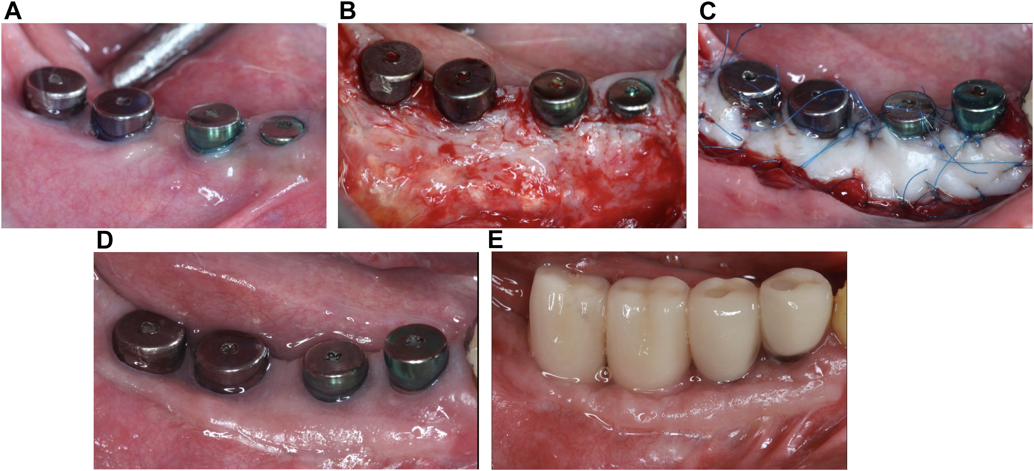 A multi-panel clinical photo shows guided bone regeneration, implant placement, soft tissue grafting, and healing for posterior mandibular implant-supported fixed partial denture.