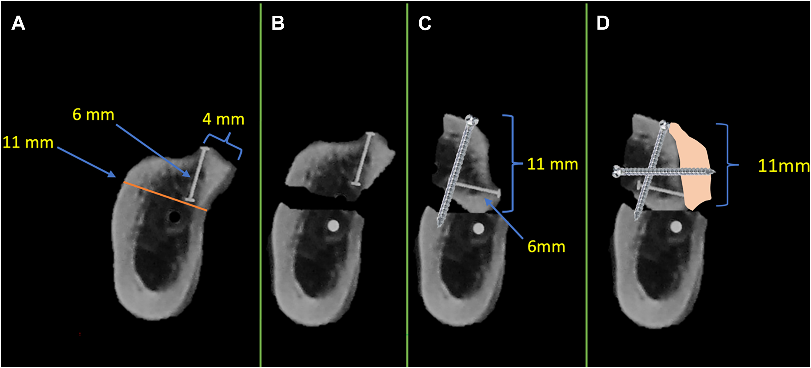 A set of four labeled panels A to D shows sequential mandibular bone sections with dimensions and fixation using screws and graft material.