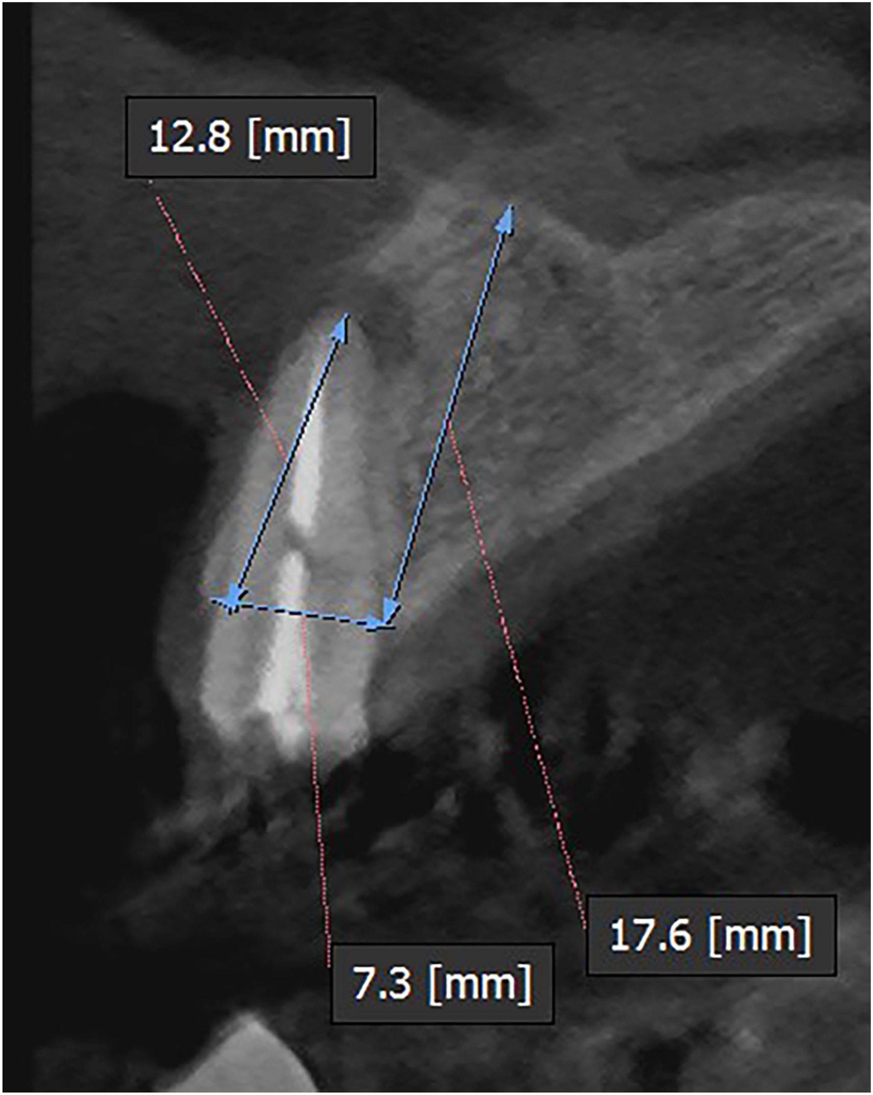 A sagittal dental scan shows a tooth root with labeled measurements in millimeters along different reference lines.