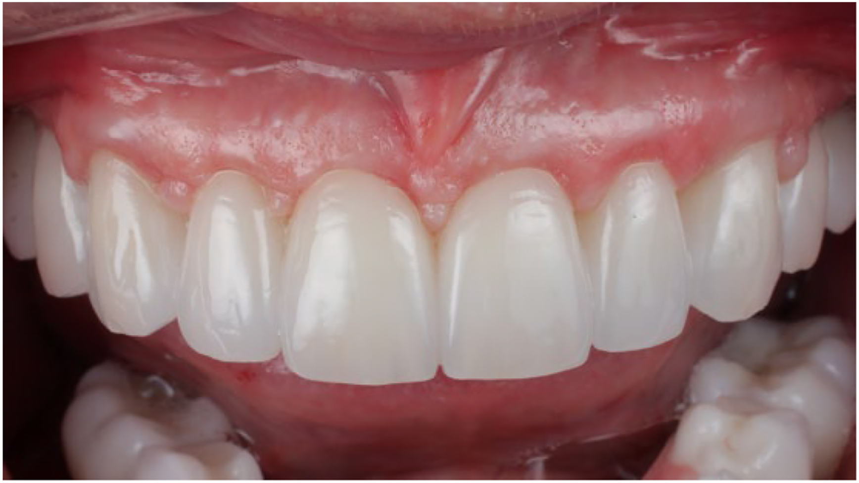 A clinical photo shows a dental prosthesis with teeth and attachments in an open mouth.