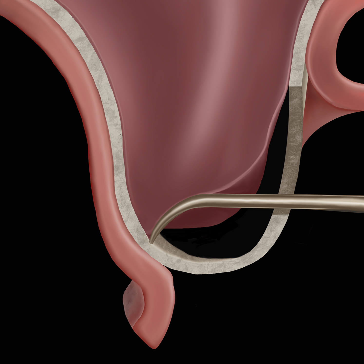 A clinical illustration shows a sinus curette lifting the Schneiderian membrane during a maxillary sinus elevation procedure, with the instrument placed between bone and membrane.