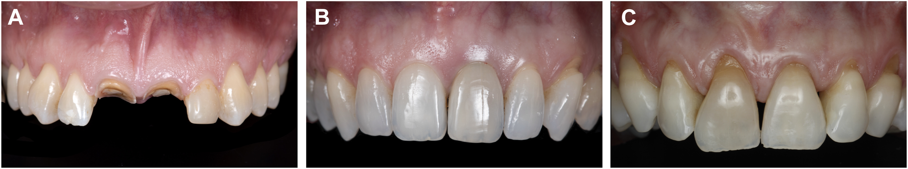 A set of three dental panels shows upper front teeth with different levels of gum margins.