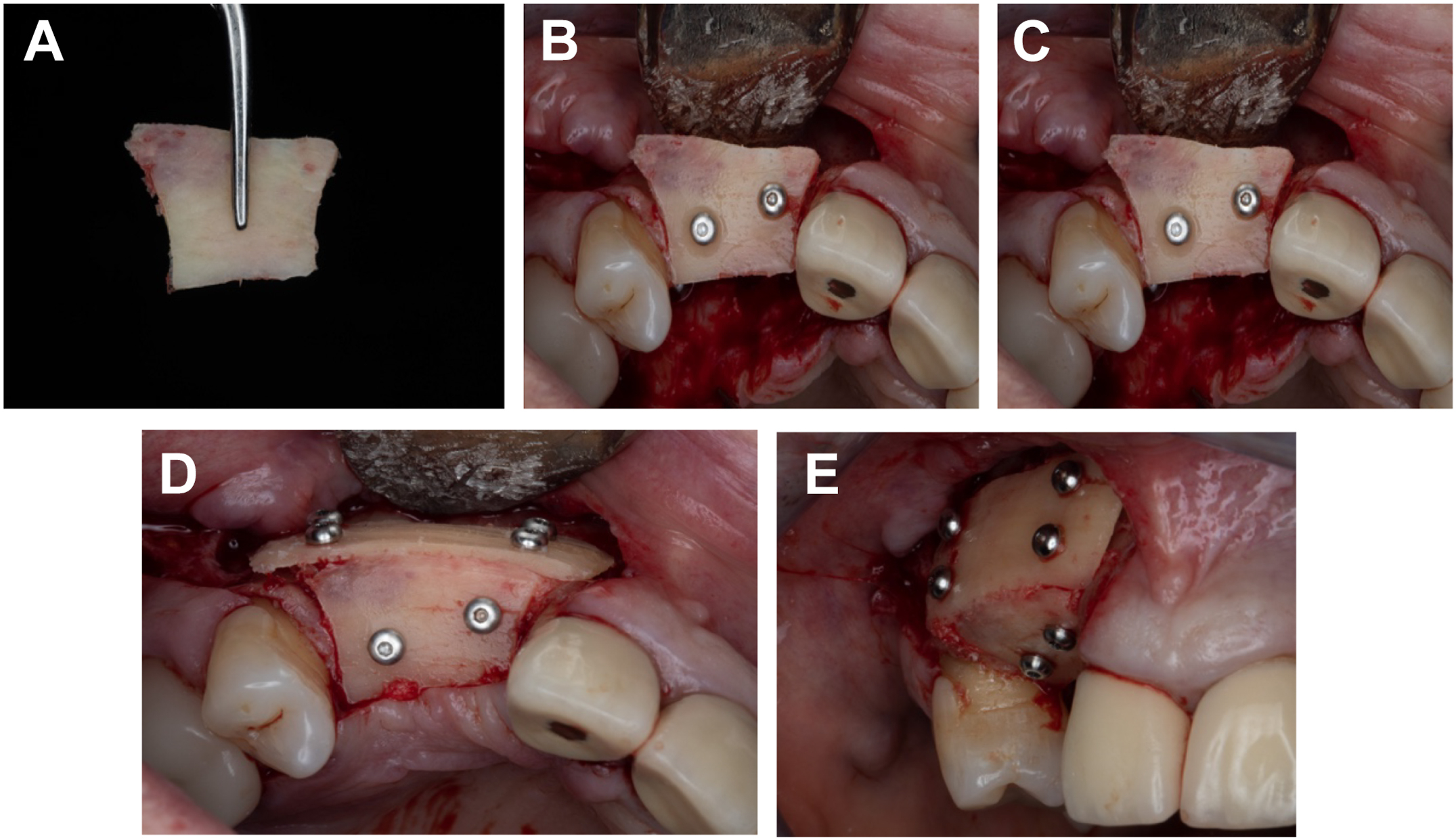Five dental photos show shaping, positioning, and fixation of a split bone block and buccal bone plate around a dental implant site using multiple screws to contour the ridge.