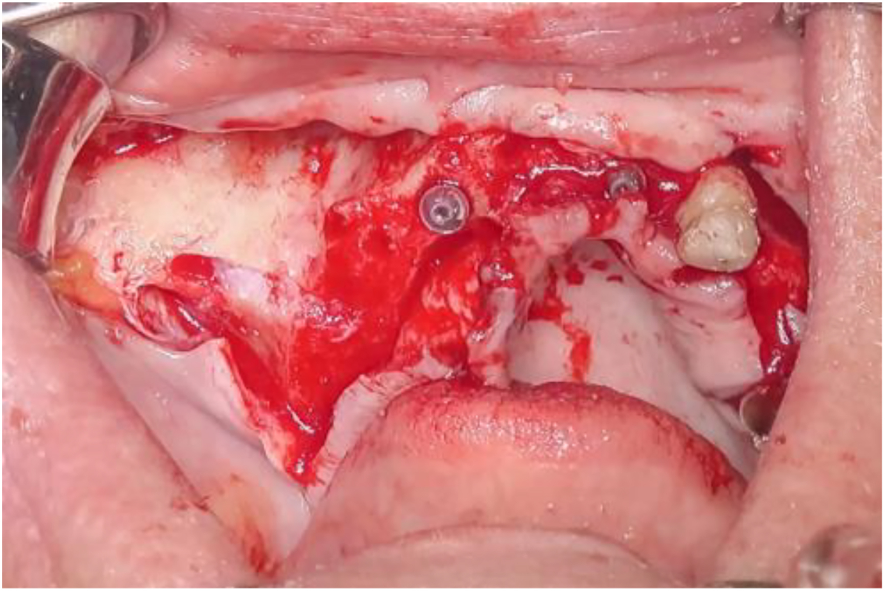 A photo of a surgical site with NanoBone layered over BioOss Collagen and an implant.