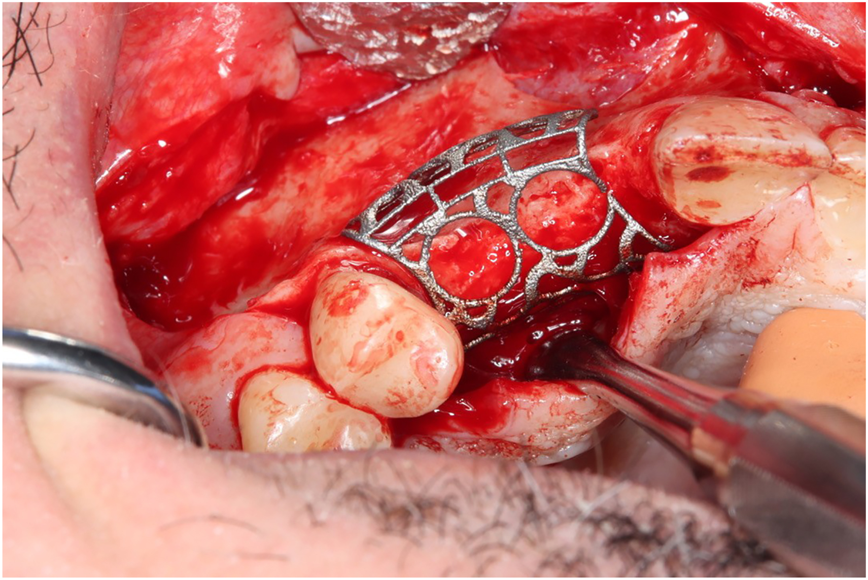 A surgical view of the mandibular posterior region with a titanium mesh secured over the alveolar bone with surgical instruments and retracted soft tissue.