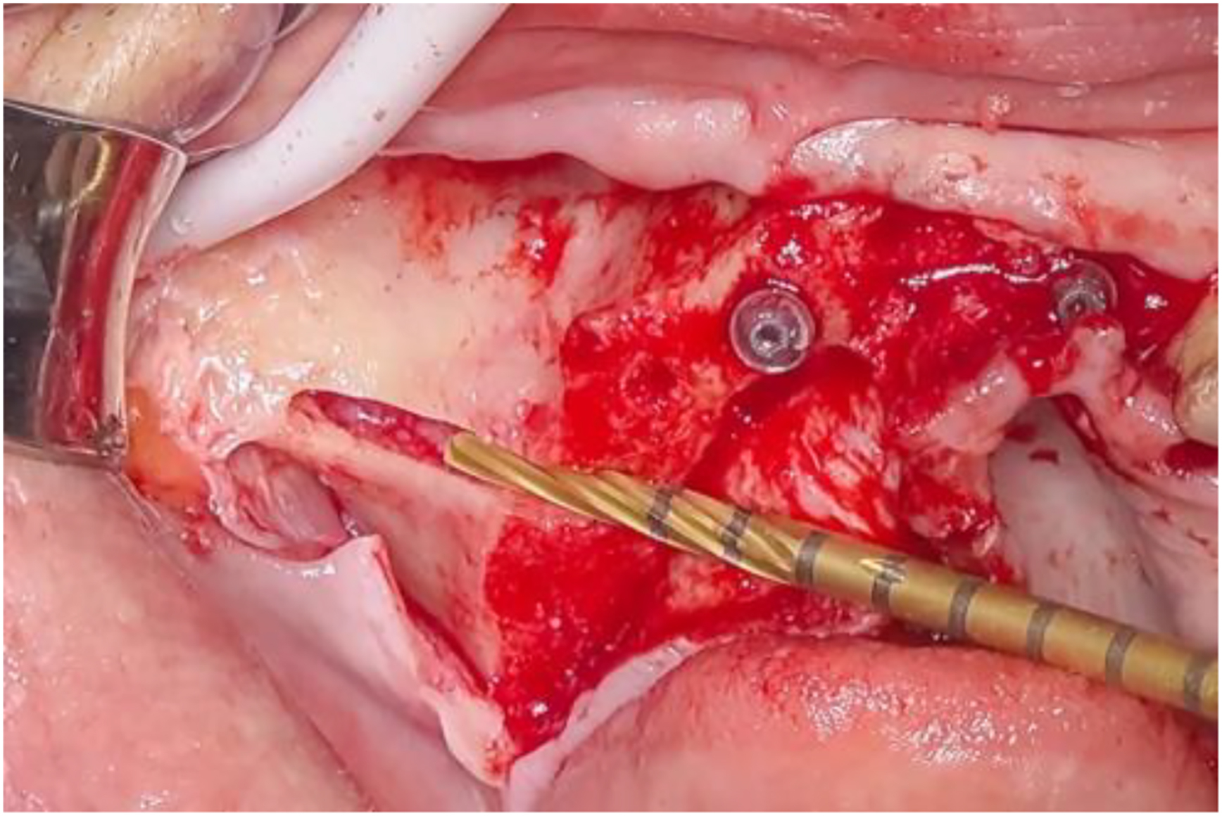 A photo shows an osteotomy with a surgical tool, screws, and exposed tissue.