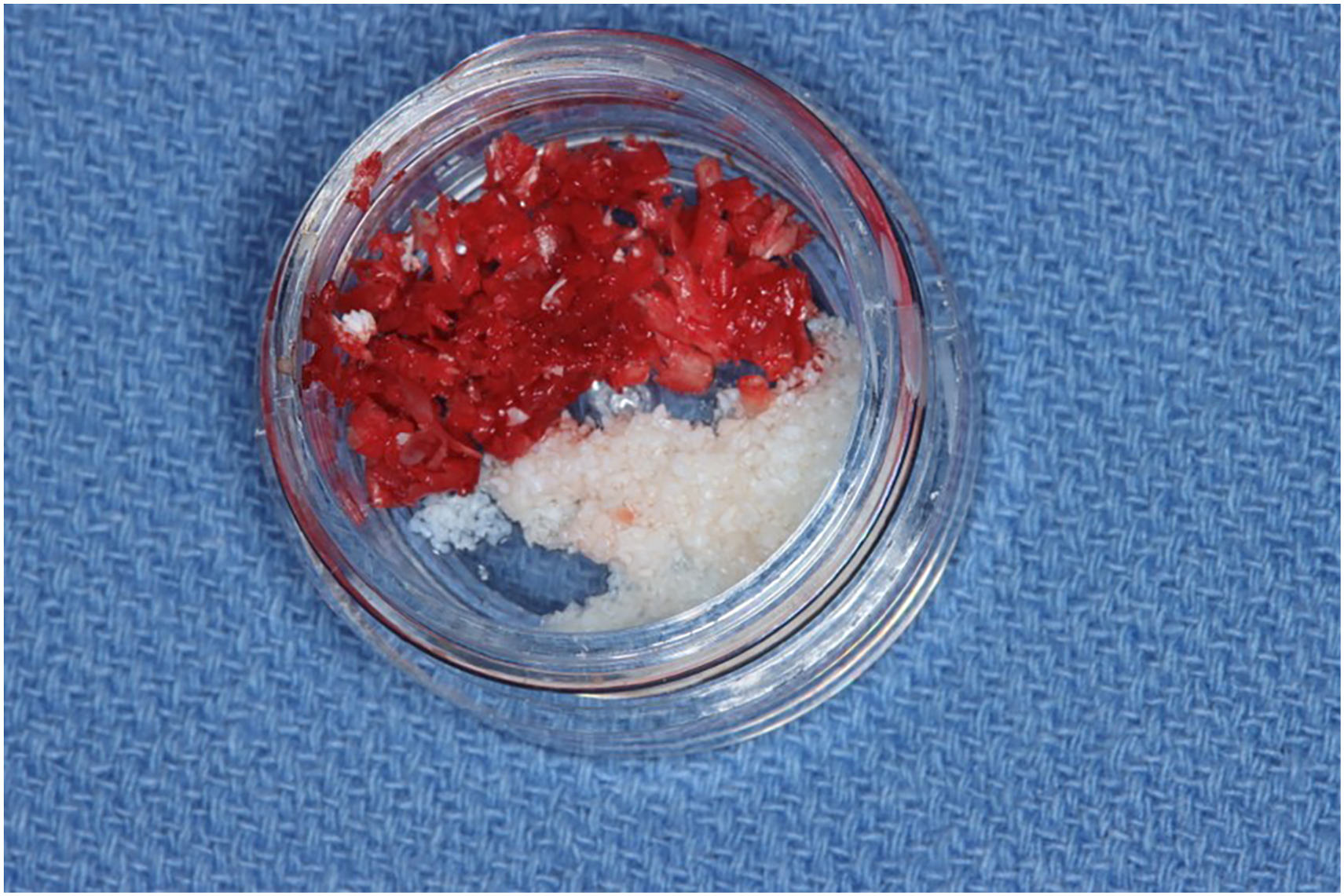 A photograph of biological material and bone graft particulate contained in a clear circular container placed on a textured surface.